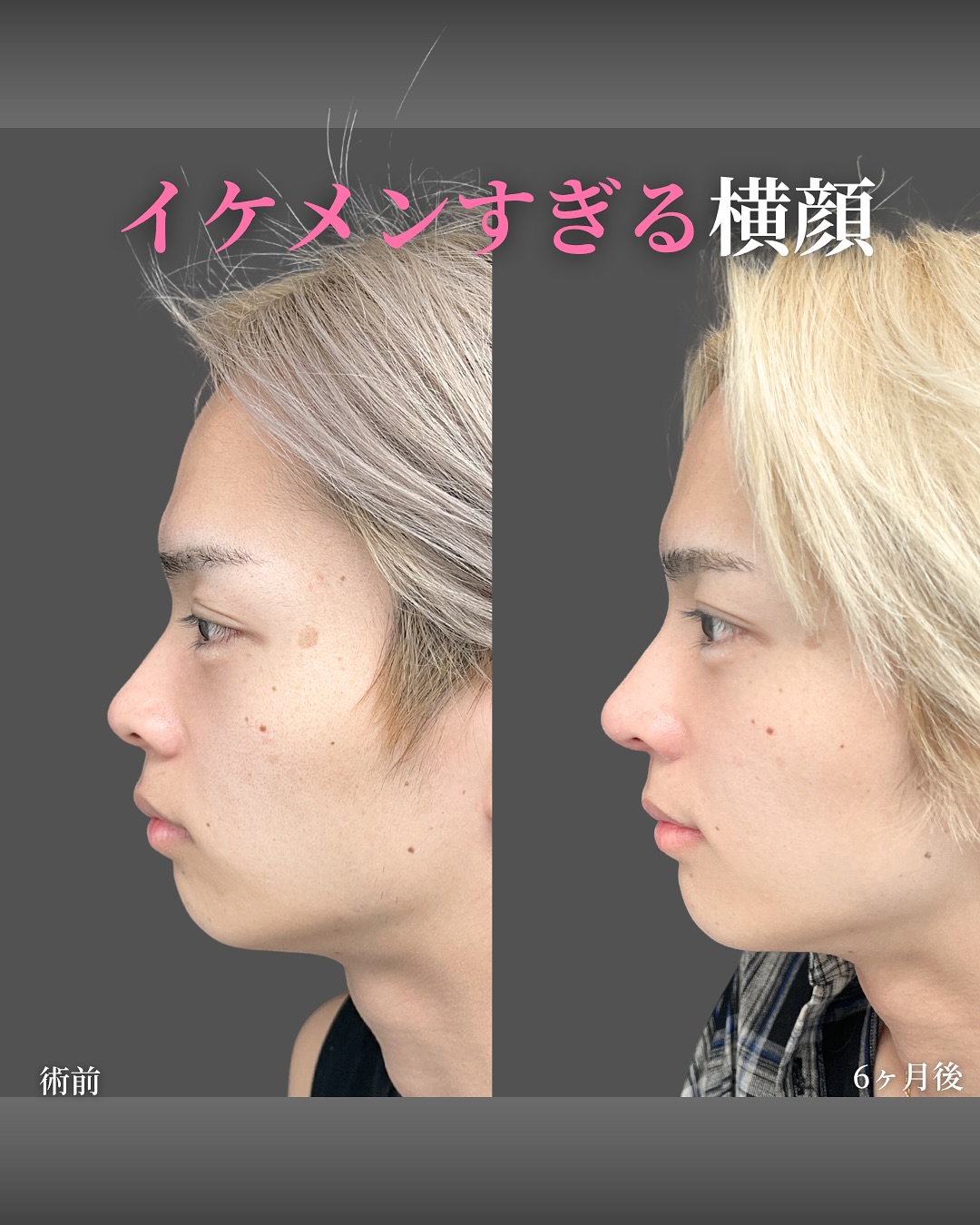 新宿院で行った鼻整形の名医の吉原伯医師のMD式のオーダーメイドプロテーゼと鼻尖形成3D法と軟骨移植と小鼻縮小内外側法と鼻柱下降術の症例写真