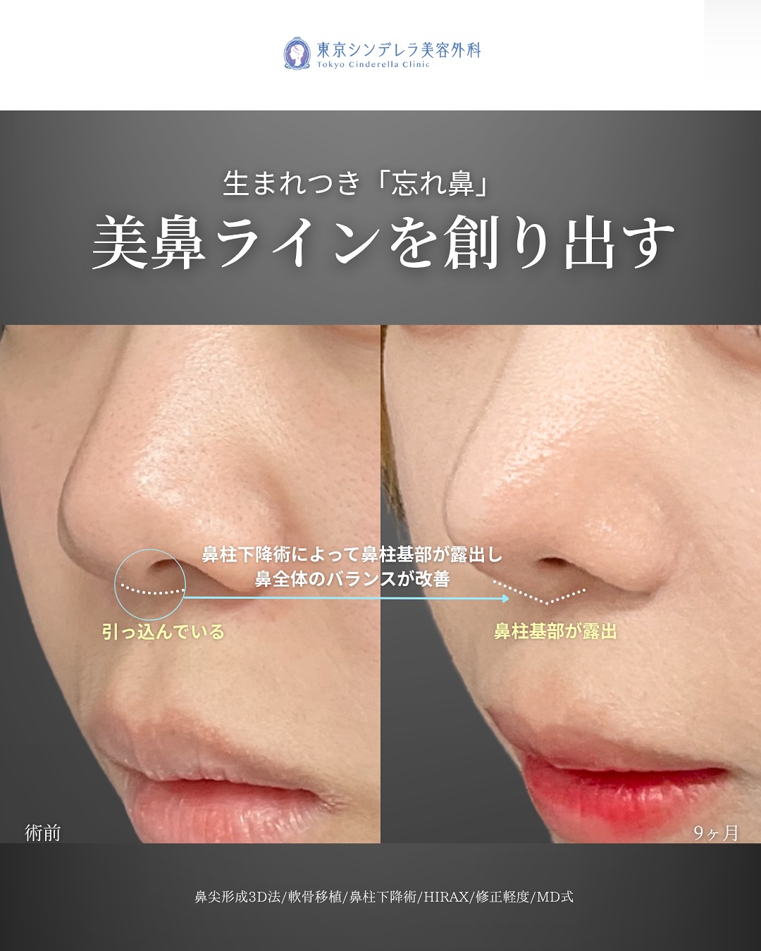 新宿院で行った鼻整形の名医の吉原伯医師のMD式の鼻尖形成3D法と軟骨移植と鼻柱下降術とHIRAXと他院修正の症例写真