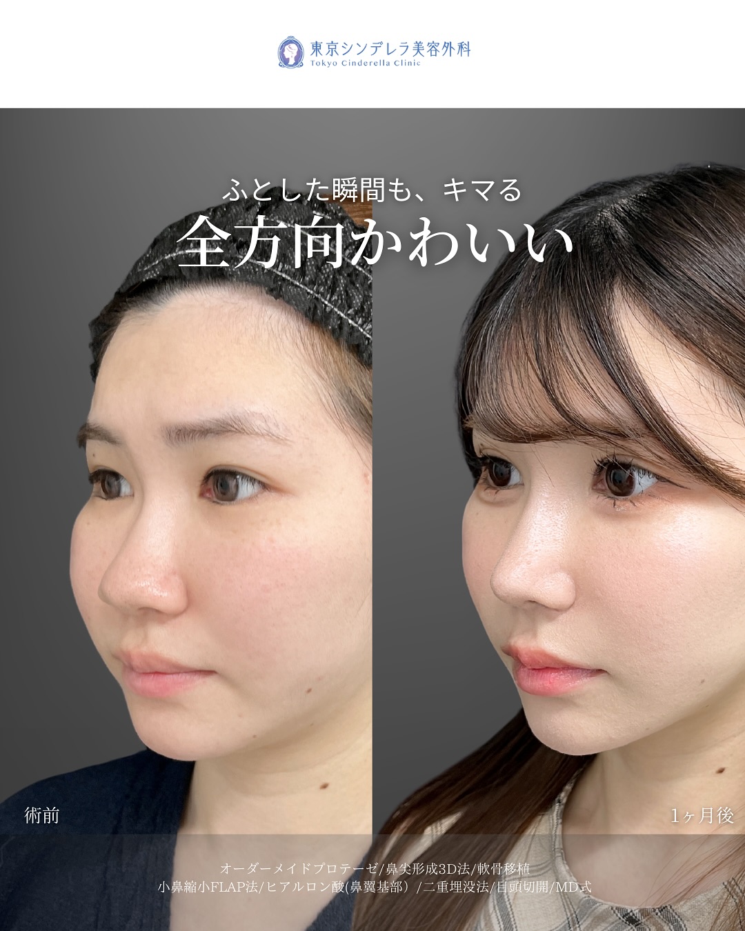 新宿院で行った二重整形の名医の吉原伯医師のMD式の鼻尖形成3D法と軟骨移植と小鼻縮小FLAP法とヒアルロン酸(鼻翼基部)と二重埋没法と目頭切開の症例写真