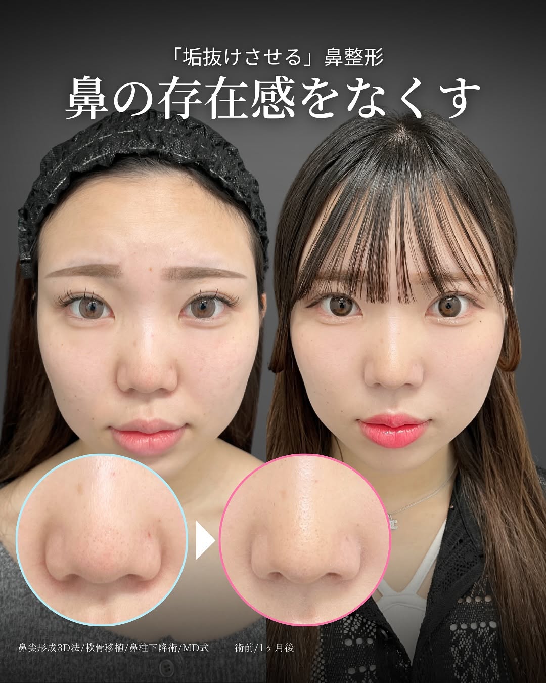 新宿院で行った鼻整形の名医の吉原伯医師のMD式の鼻尖形成3D法と軟骨移植と鼻柱下降術の症例写真