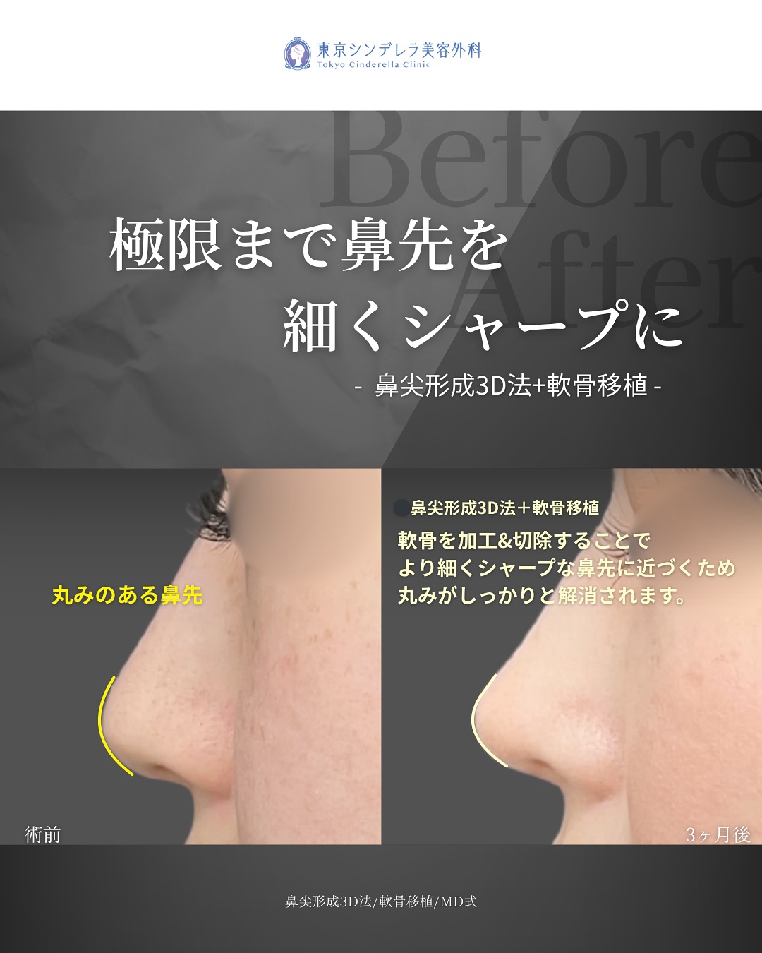 新宿院で行った鼻整形の名医の吉原伯医師のMD式の鼻尖形成3D法と軟骨移植の症例写真