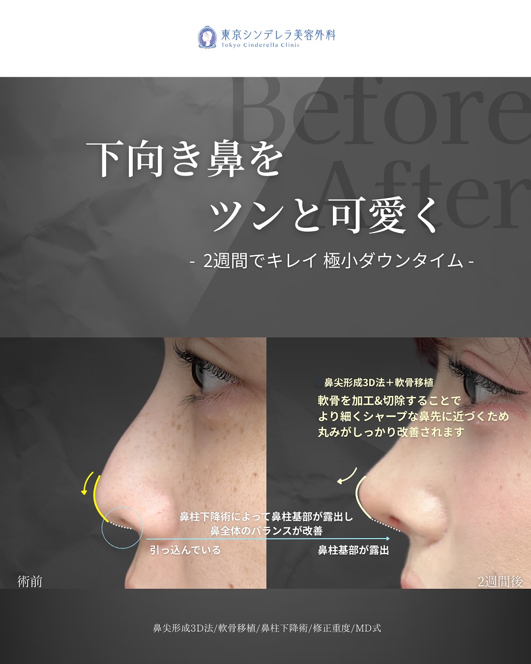 新宿院で行った鼻整形の名医の吉原伯医師のMD式の鼻尖形成3D法と軟骨移植の症例写真