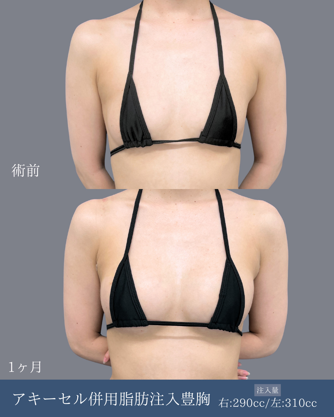 新宿院で行ったアキーセル併用脂肪注入豊胸の名医の吉原伯医師の症例写真