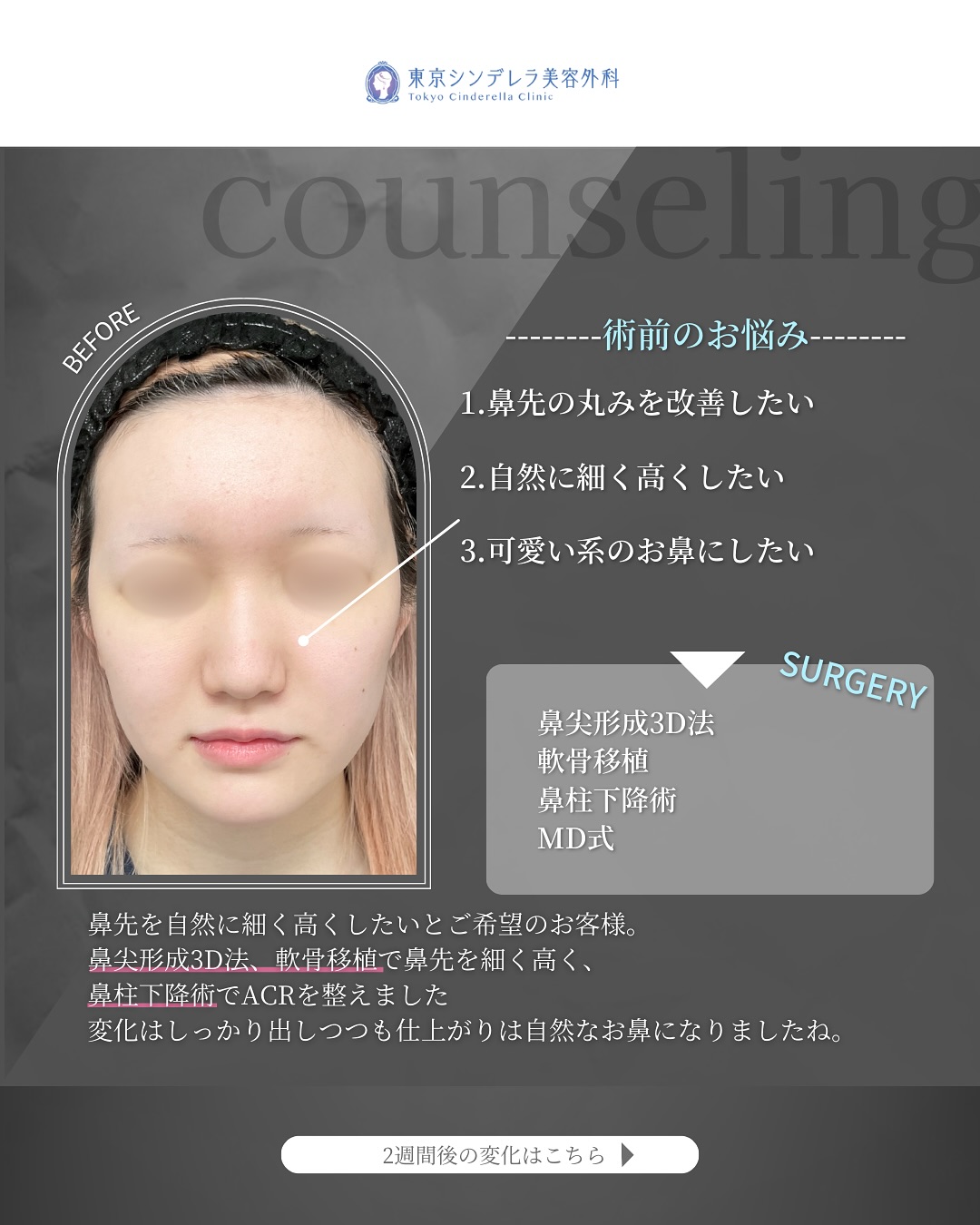 新宿院で行った鼻整形の名医の吉原伯医師のMD式の鼻尖形成3D法と軟骨移植と鼻柱下降術の症例写真