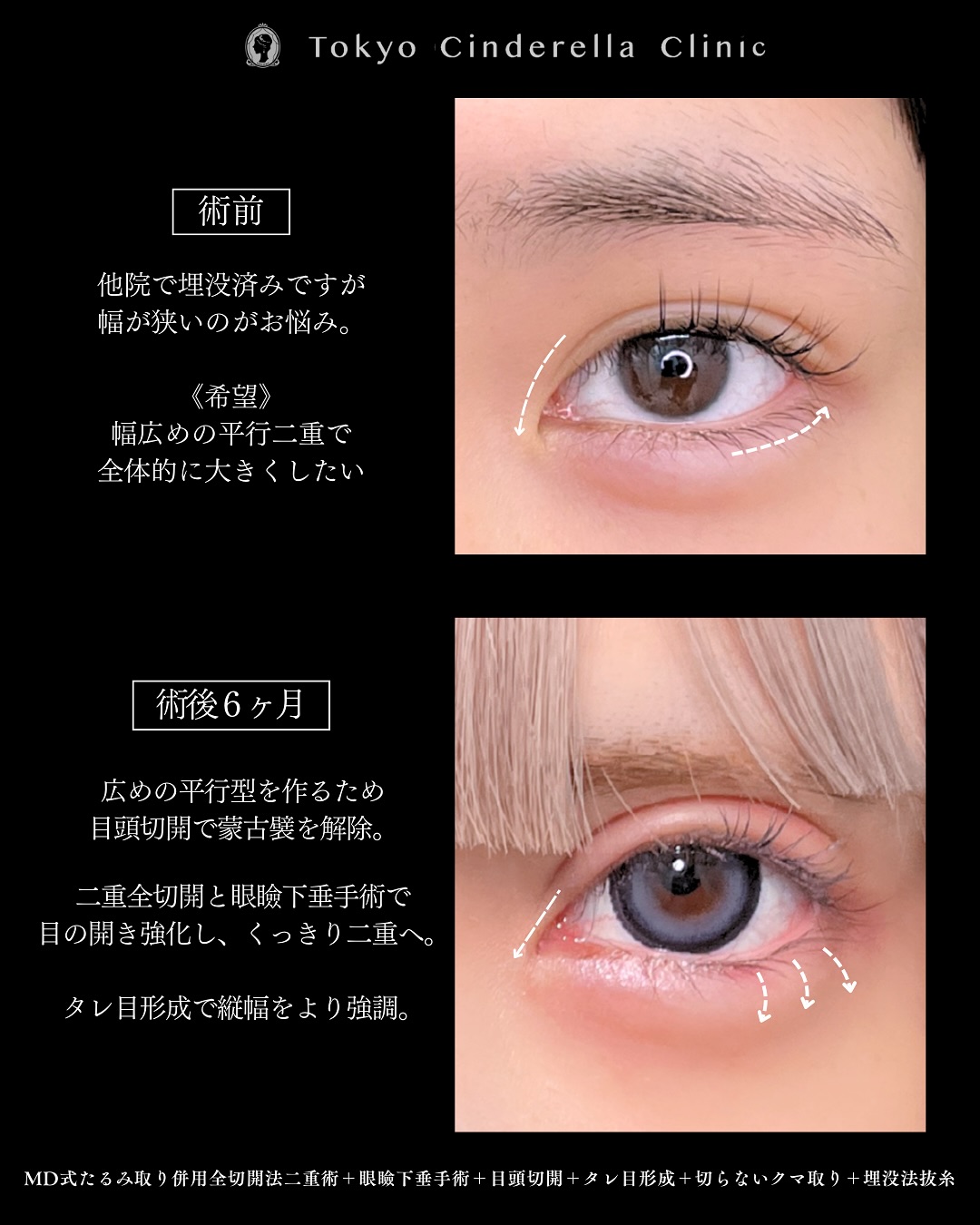 新宿院で行った二重整形で有名な吉原伯医師のMD式のたるみ取り併用全切開法二重術と眼瞼下垂手術と目頭切開とタレ目形成(結膜切開)と切らないクマ取りと埋没法抜糸6ヶ月後の症例写真
