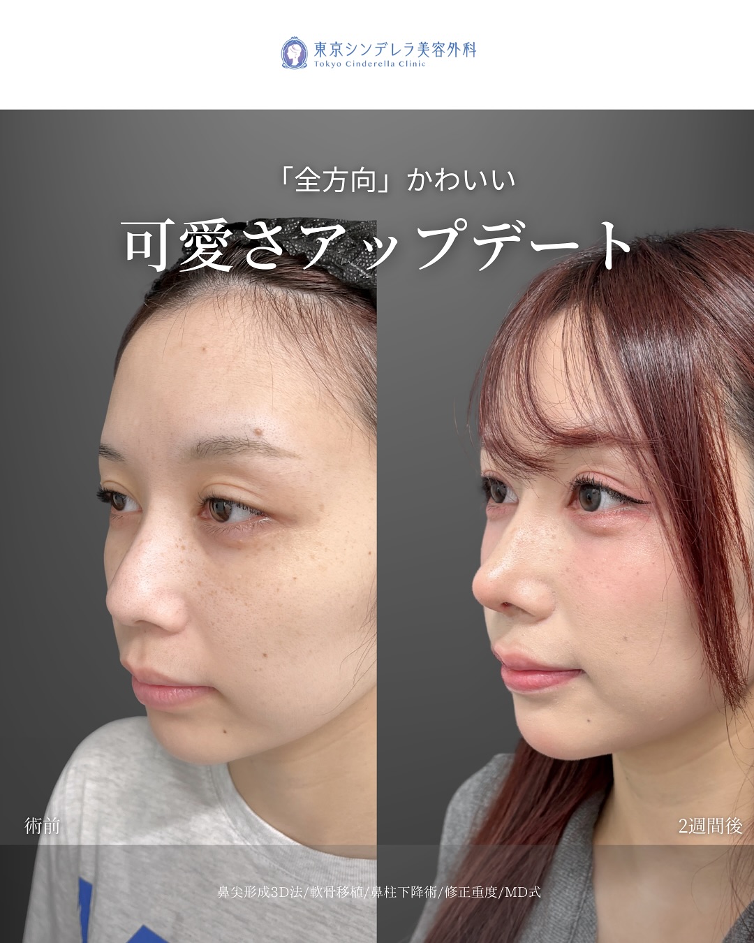 新宿院で行った鼻整形の名医の吉原伯医師のMD式の鼻尖形成3D法と軟骨移植の症例写真