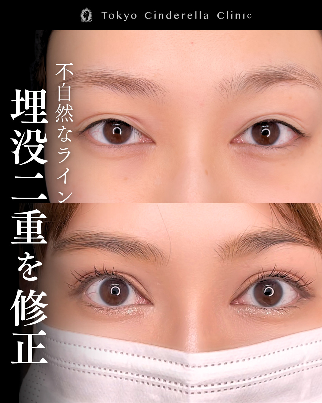 新宿院で行った二重整形で有名な吉原伯医師のMD式のたるみ取り併用全切開法二重術と眼瞼下垂手術と他院修正の3ヶ月後の症例写真