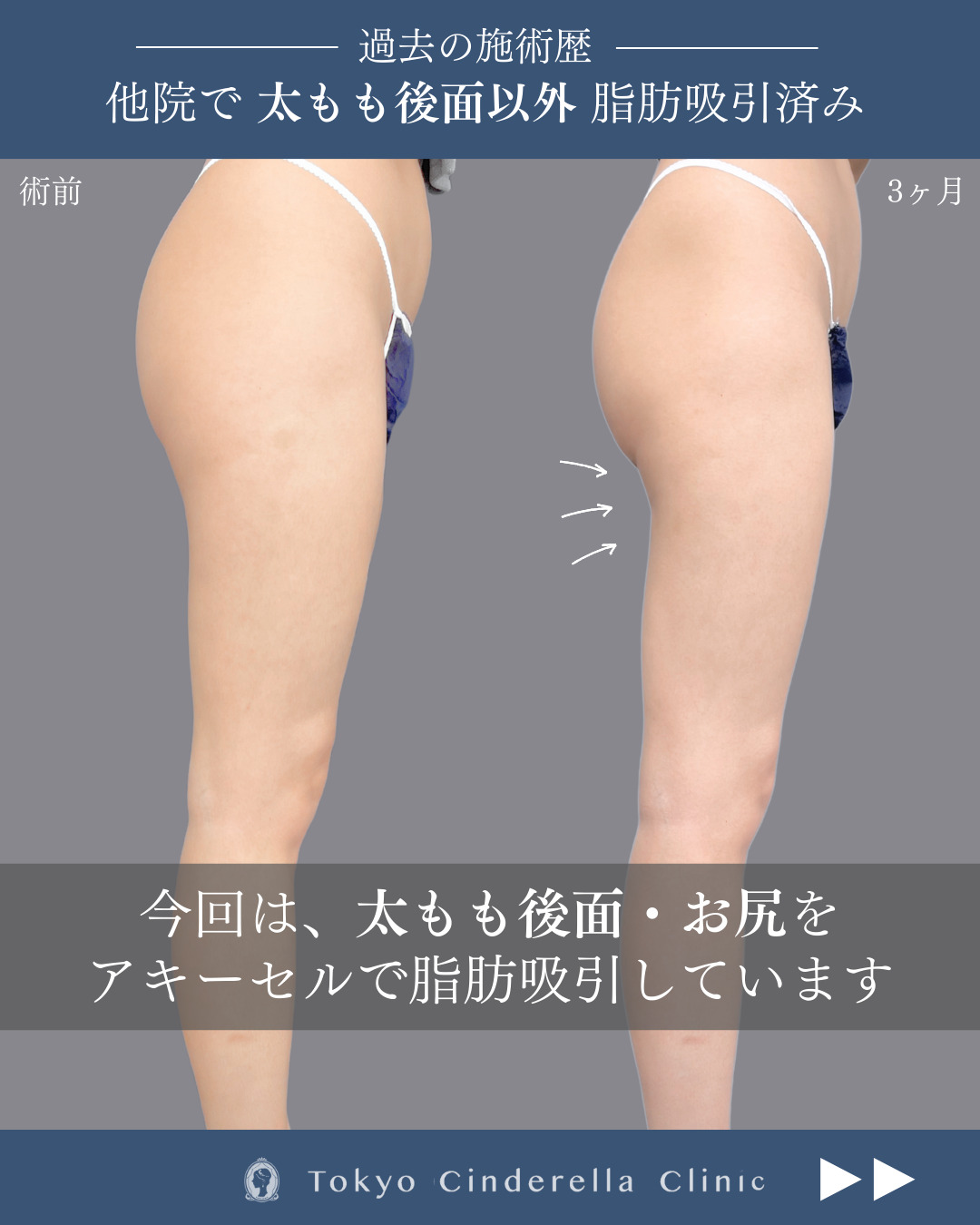 新宿院で行ったアキーセル脂肪吸引(太もも後面・お尻)の名医の吉原伯医師の症例写真