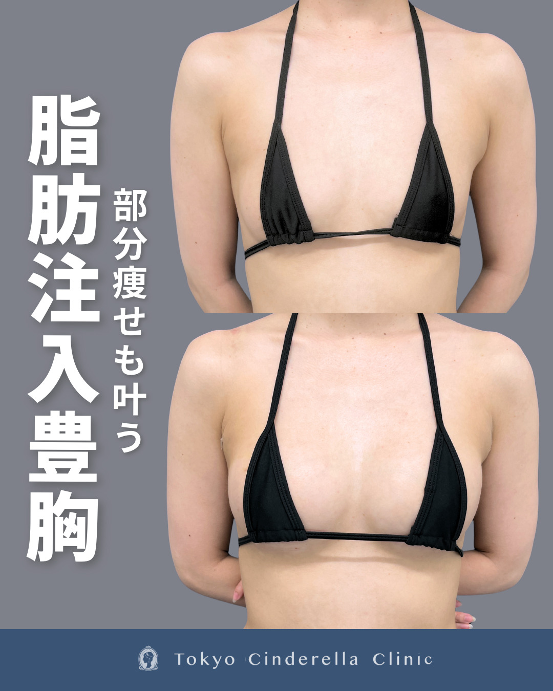 新宿院で行ったアキーセル併用脂肪注入豊胸の名医の吉原伯医師の症例写真