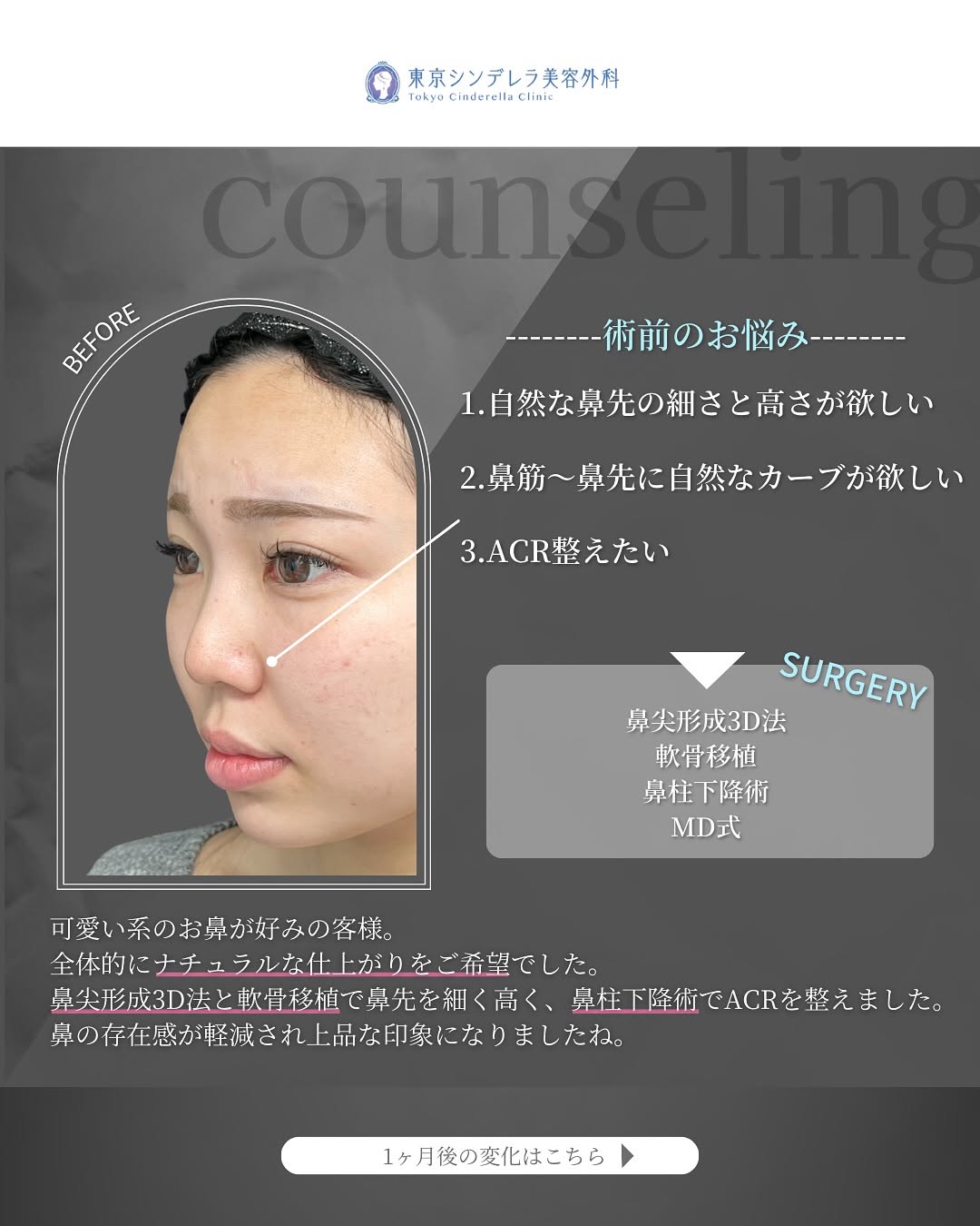 新宿院で行った鼻整形の名医の吉原伯医師のMD式の鼻尖形成3D法と軟骨移植と鼻柱下降術の症例写真