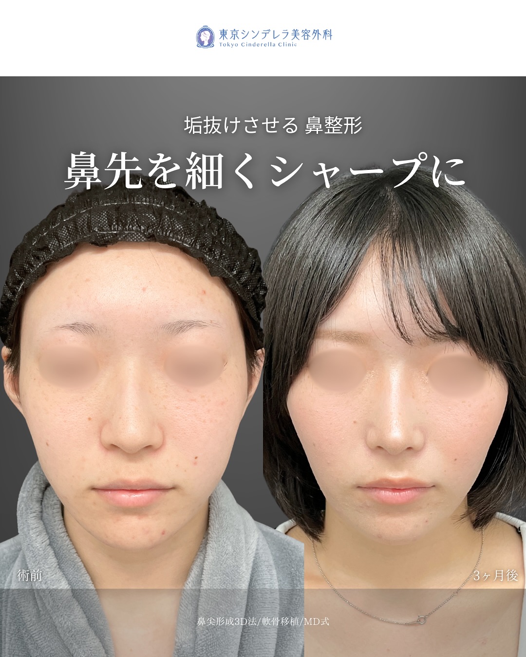 新宿院で行った鼻整形の名医の吉原伯医師のMD式の鼻尖形成3D法と軟骨移植の症例写真