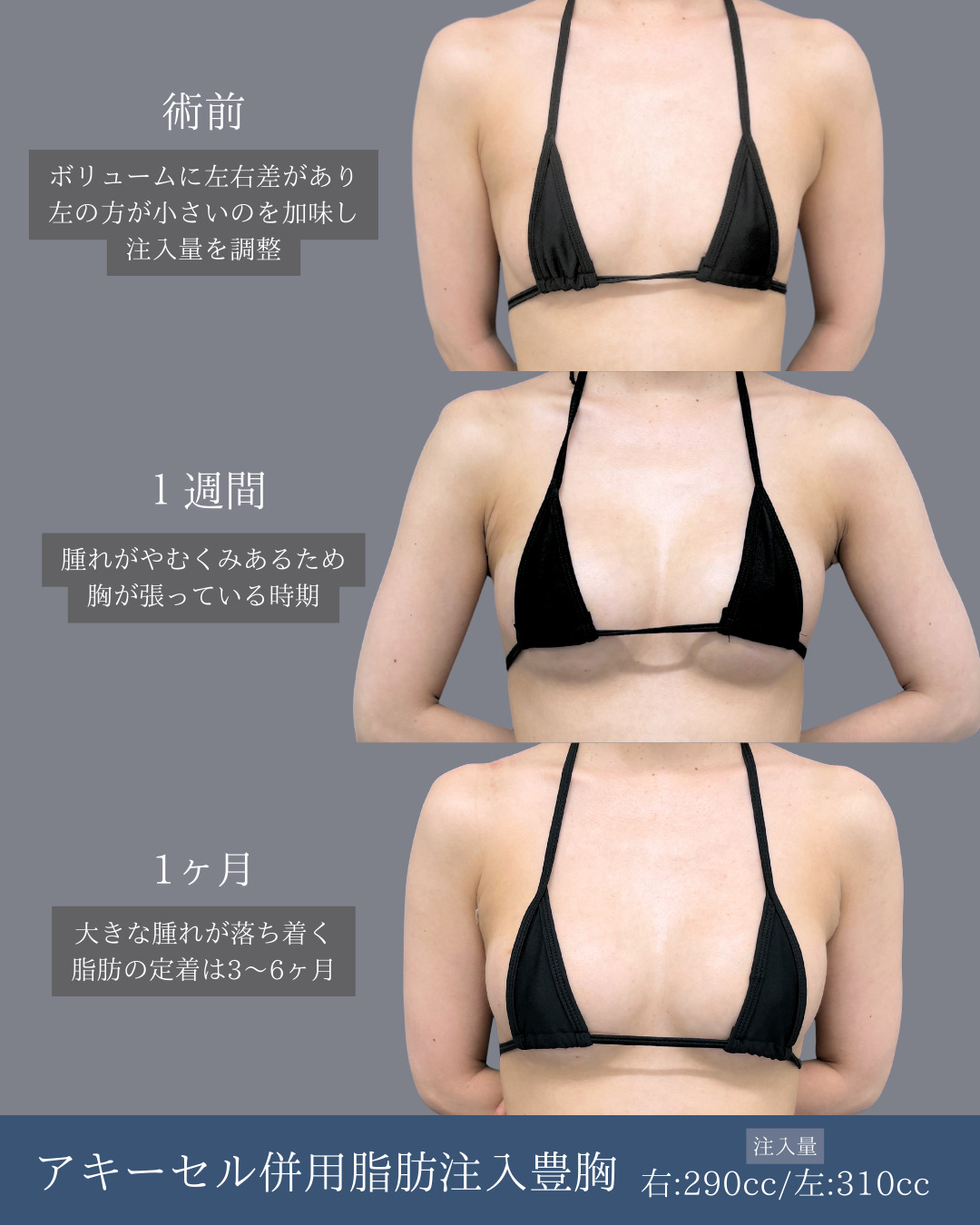 新宿院で行ったアキーセル併用脂肪注入豊胸の名医の吉原伯医師の症例写真