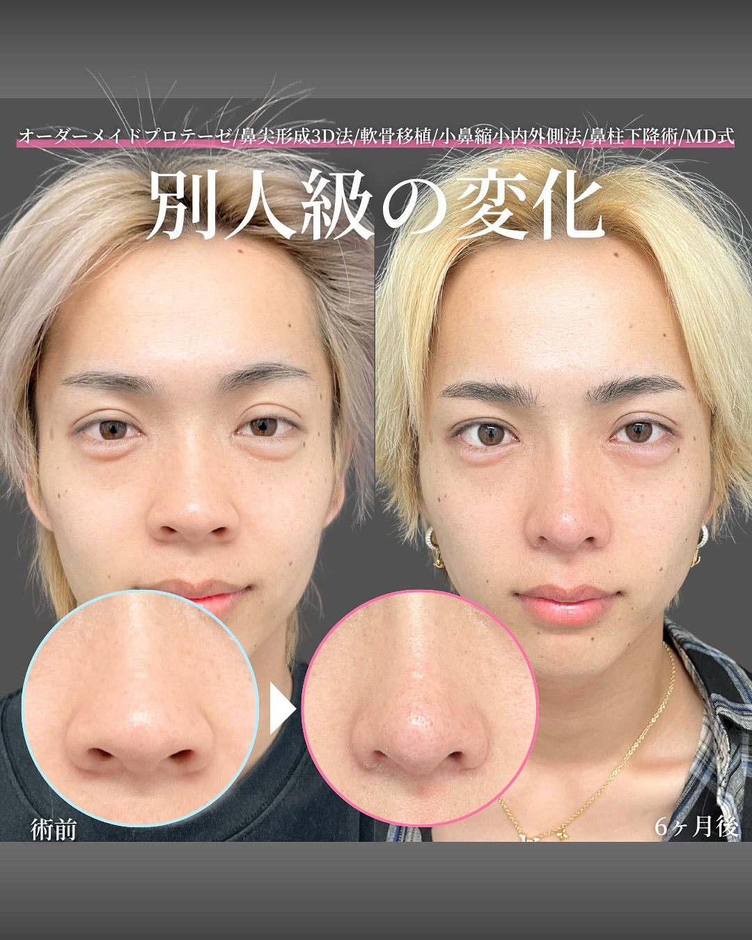 新宿院で行った鼻整形の名医の吉原伯医師のMD式のオーダーメイドプロテーゼと鼻尖形成3D法と軟骨移植と小鼻縮小内外側法と鼻柱下降術の症例写真