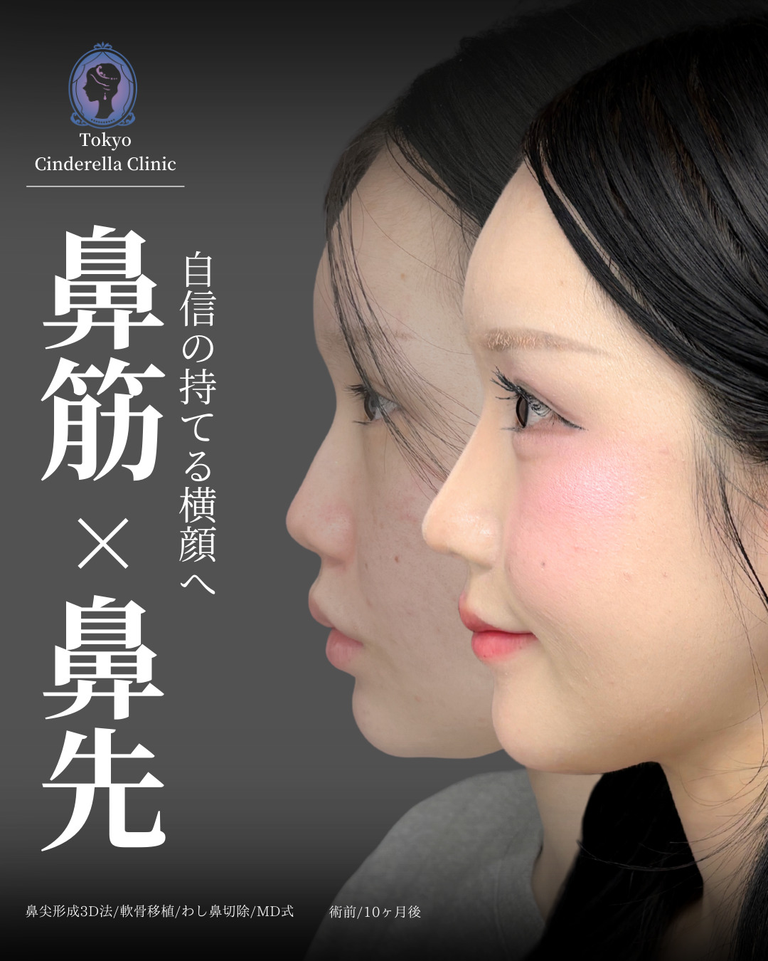鼻尖形成3D法と軟骨移植とわし鼻切除をMD式で受けた女性の症例写真