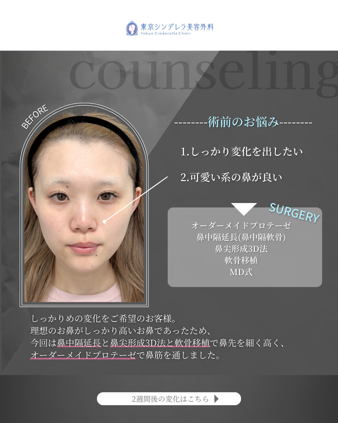 オーダーメイドプロテーゼと鼻尖形成3D法と軟骨移植と鼻中隔延長鼻中隔軟骨をMD式で受けた女性の症例写真