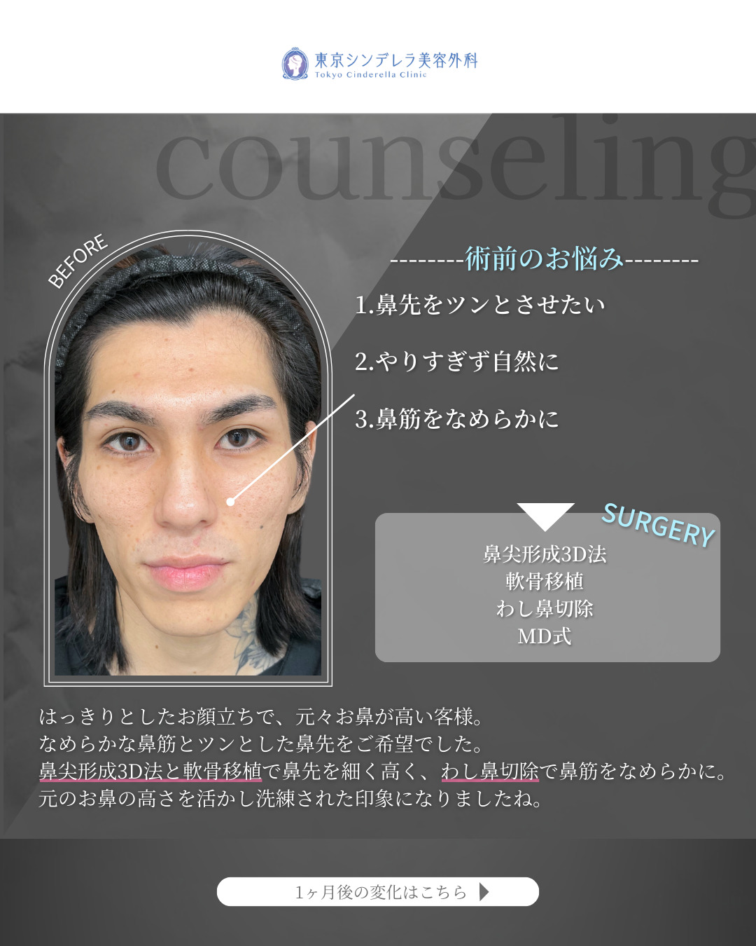 鼻尖形成3D法と軟骨移植とわし鼻切除をMD式で受けた男性の症例写真