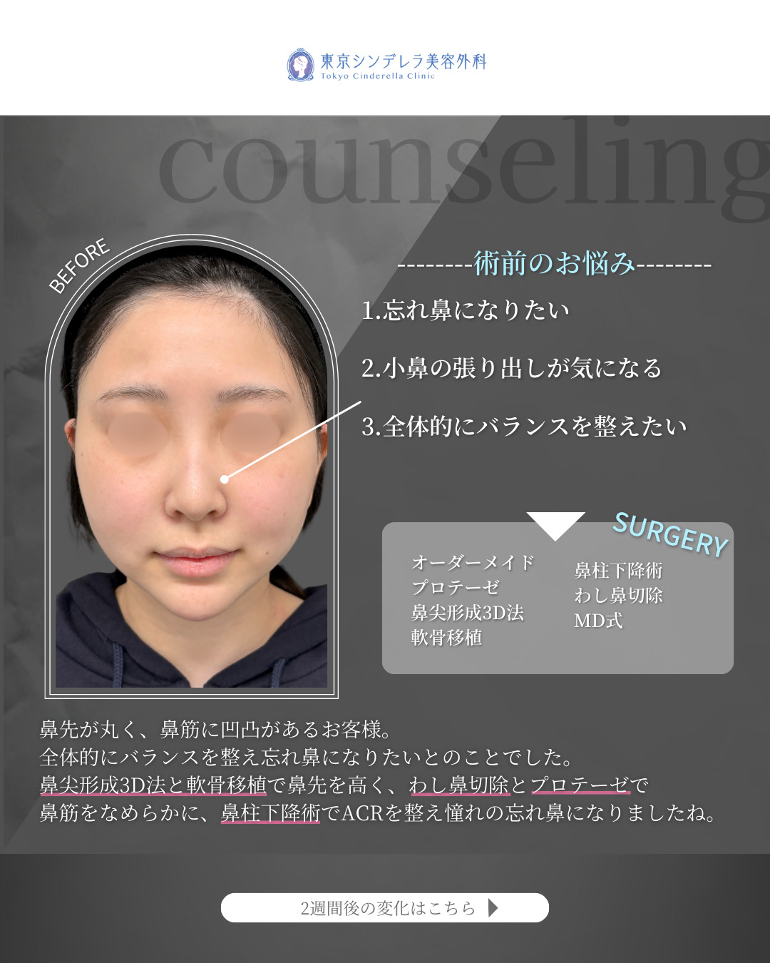 オーダーメイドプロテーゼと鼻尖形成3D法と軟骨移植と鼻柱下降術とわし鼻切除をMD式で受けた20代の女性の症例