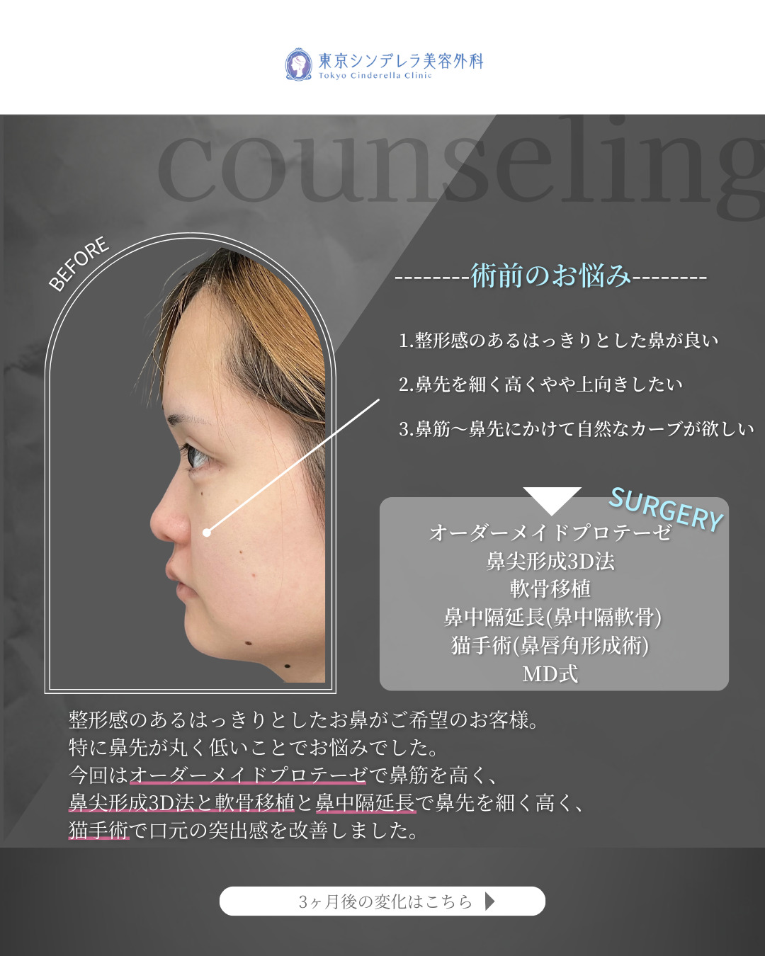 オーダーメイドプロテーゼと鼻尖形成3D法と軟骨移植と鼻中隔延長(鼻中隔軟骨)と猫手術(プロテーゼ)をMD式で受けた女性の症例写真