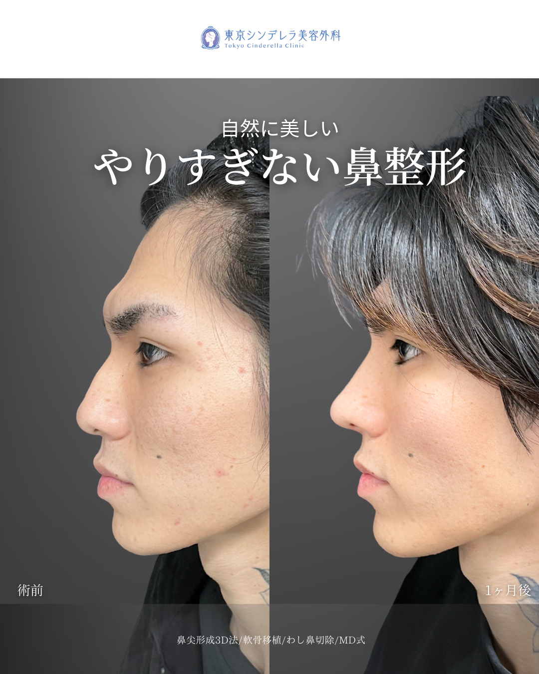 鼻尖形成3D法と軟骨移植とわし鼻切除をMD式で受けた男性の症例写真