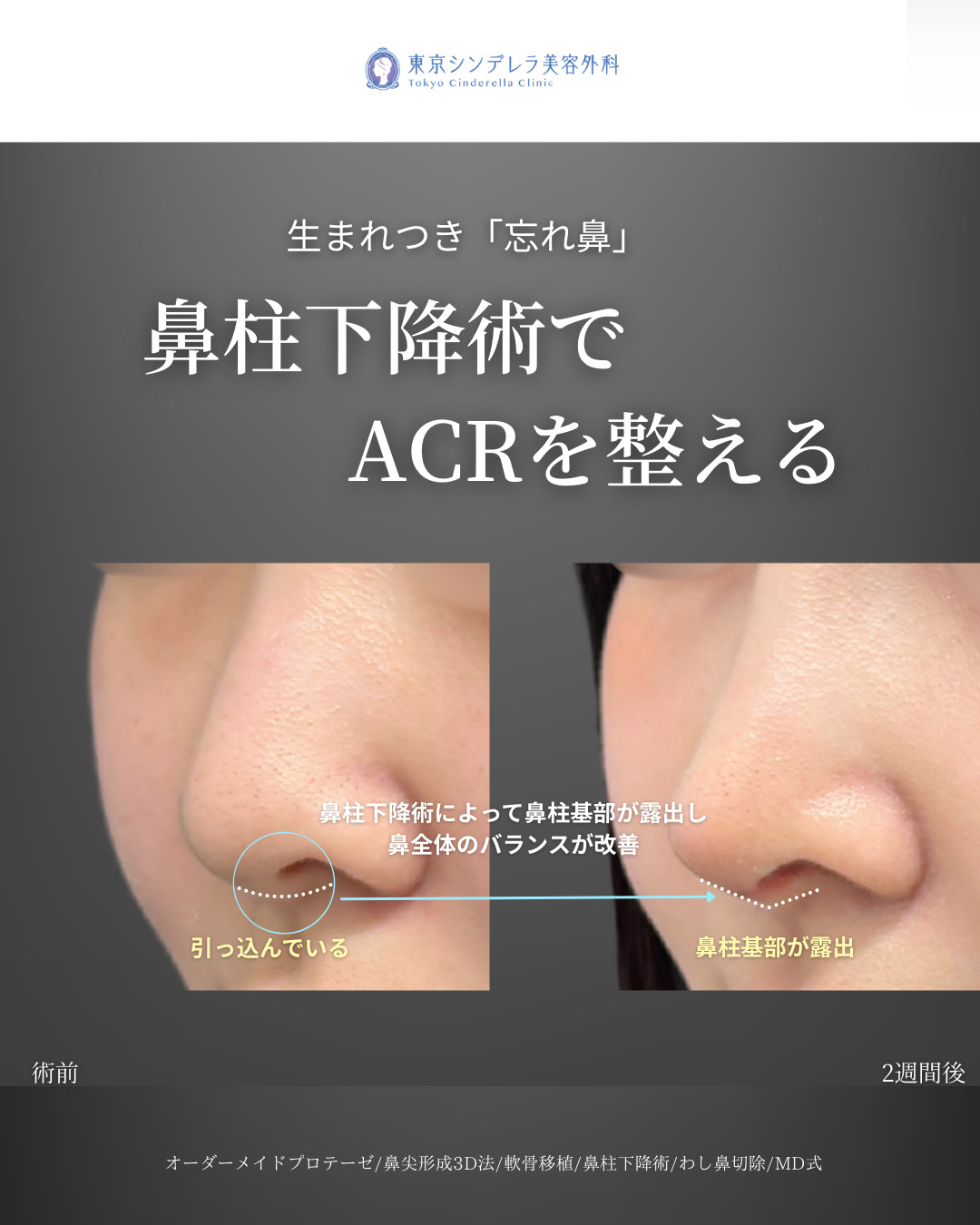 オーダーメイドプロテーゼと鼻尖形成3D法と軟骨移植と鼻柱下降術とわし鼻切除をMD式で受けた20代の女性の症例