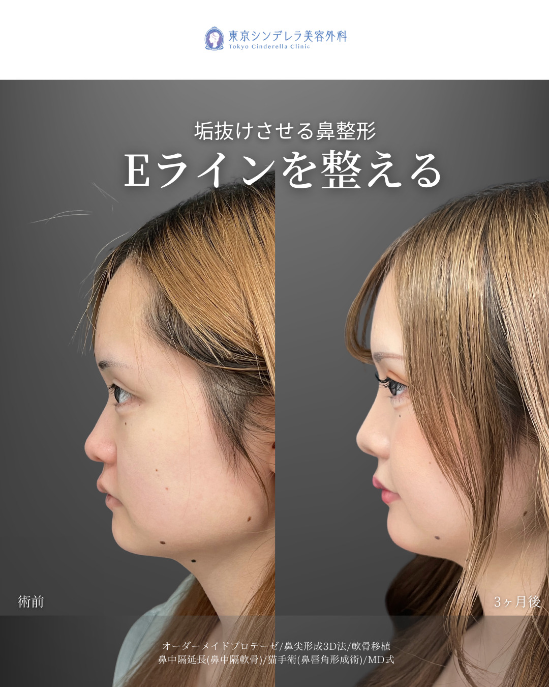 オーダーメイドプロテーゼと鼻尖形成3D法と軟骨移植と鼻中隔延長(鼻中隔軟骨)と猫手術(プロテーゼ)をMD式で受けた女性の症例写真