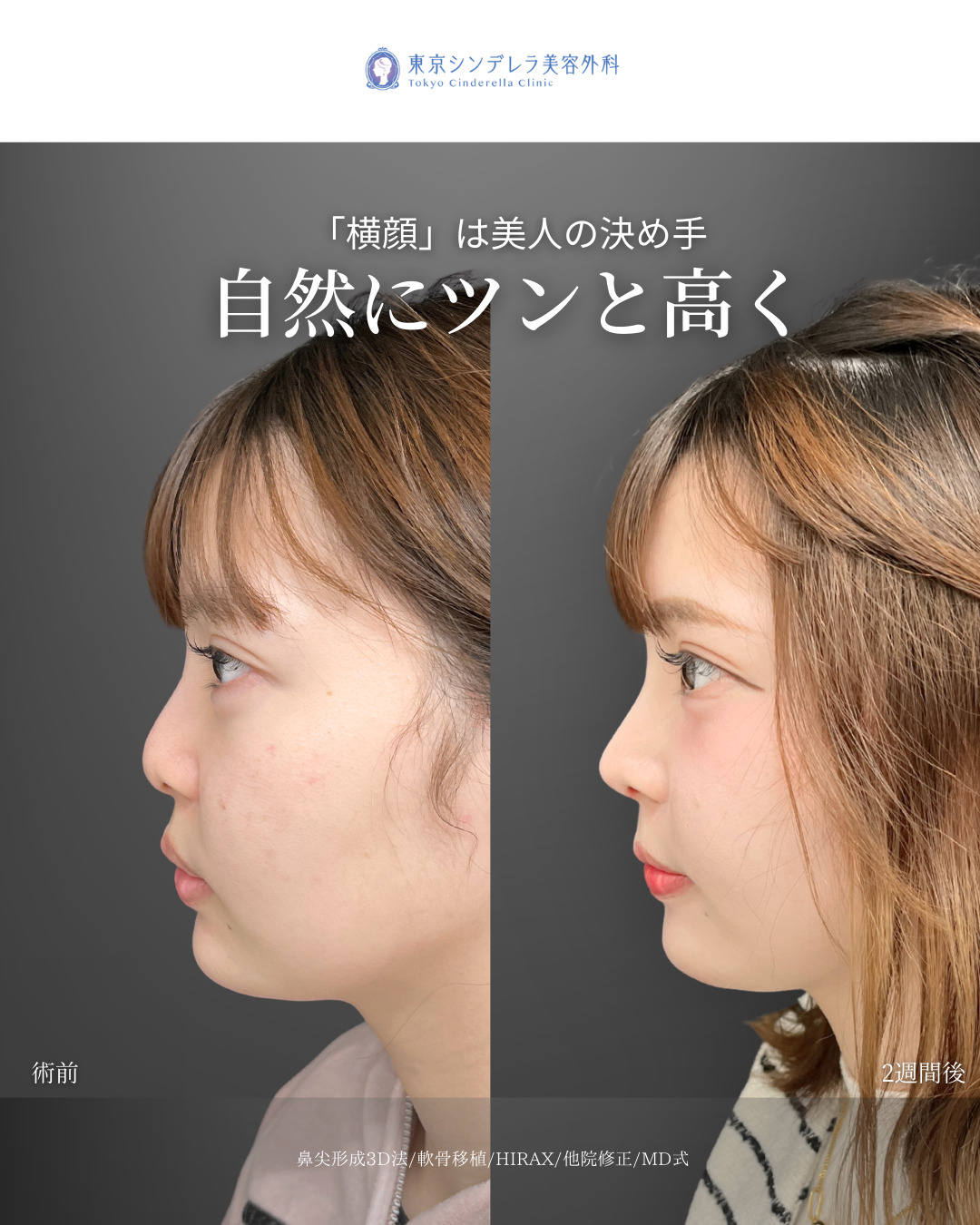 鼻尖形成3D法と軟骨移植をMD式で受けた女性の症例写真