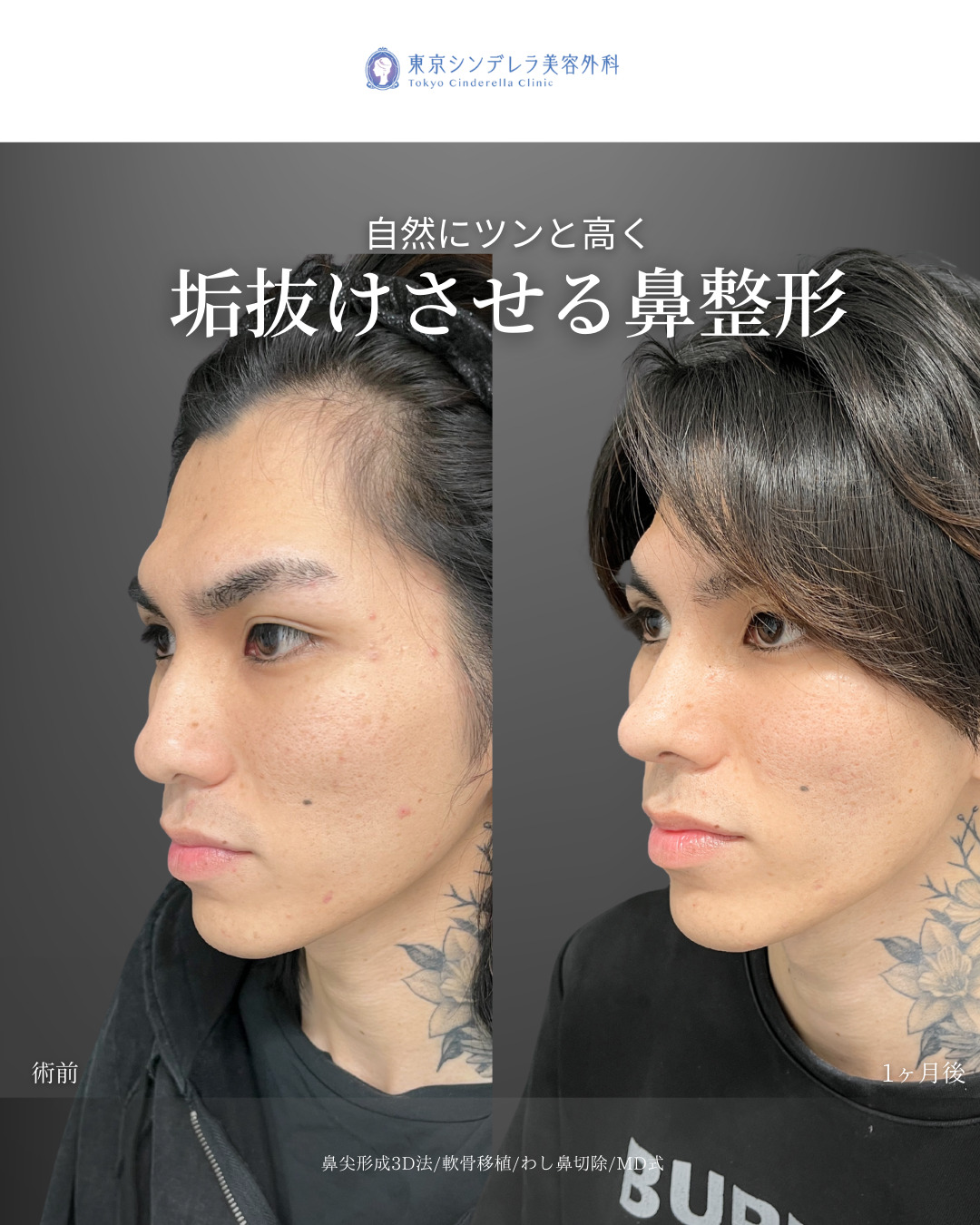 鼻尖形成3D法と軟骨移植とわし鼻切除をMD式で受けた男性の症例写真