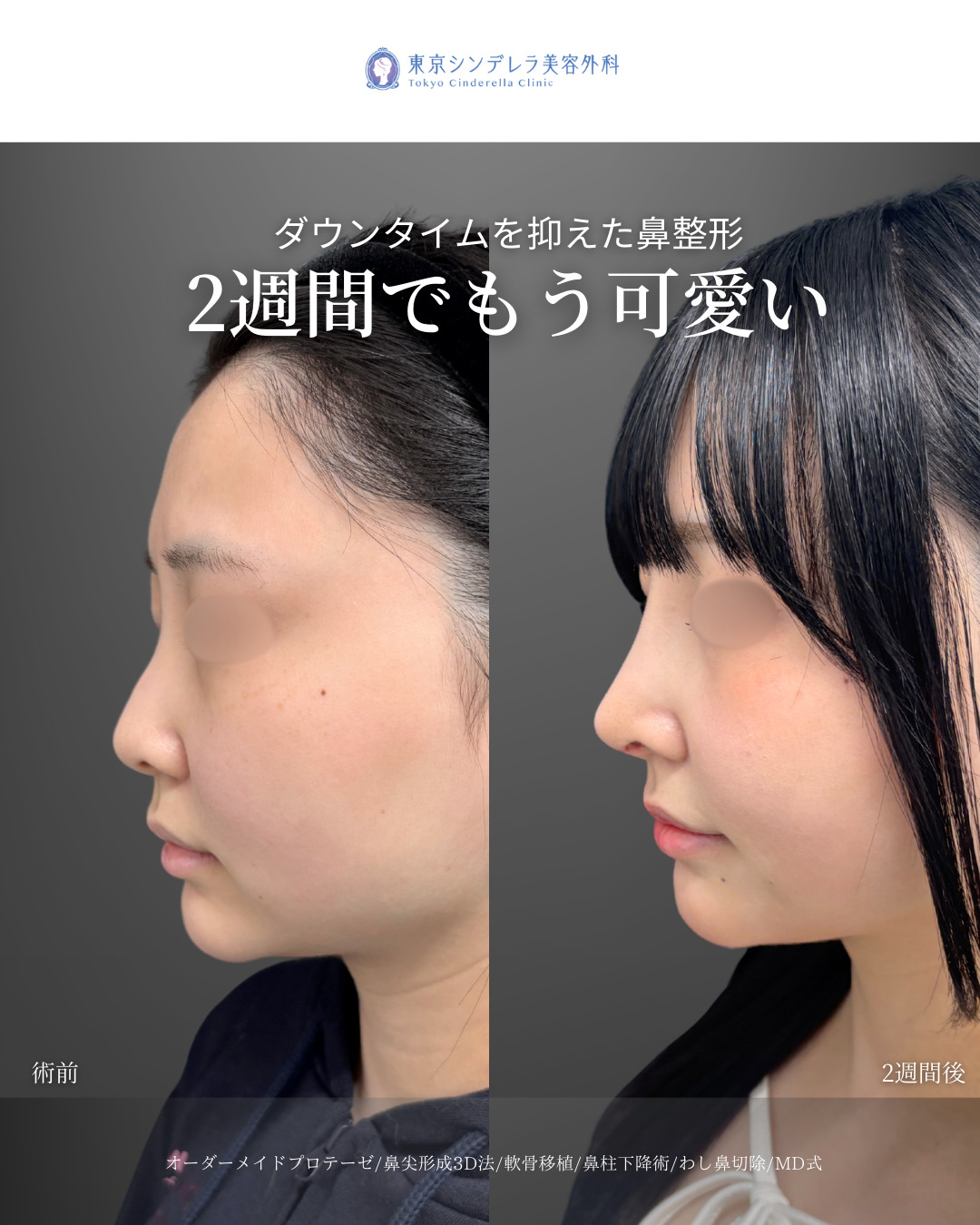 オーダーメイドプロテーゼと鼻尖形成3D法と軟骨移植と鼻柱下降術とわし鼻切除をMD式で受けた20代の女性の症例