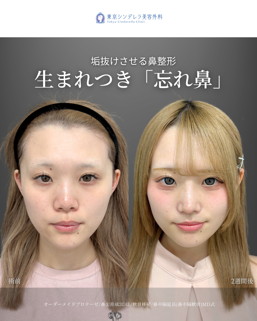 オーダーメイドプロテーゼと鼻尖形成3D法と軟骨移植と鼻中隔延長鼻中隔軟骨をMD式で受けた女性の症例写真
