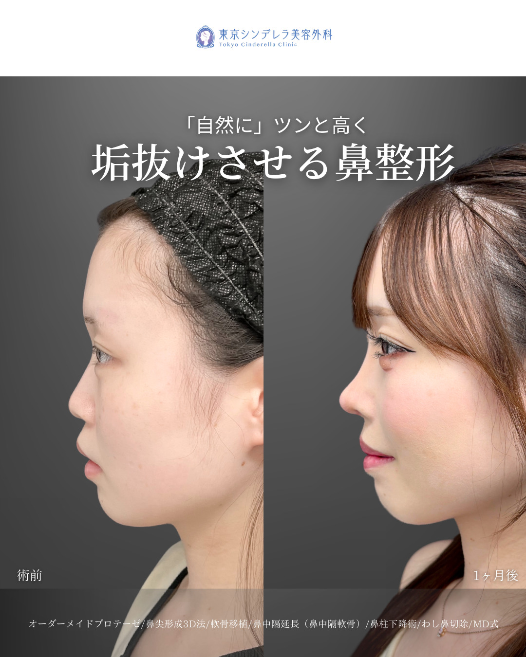 プロテーゼと鼻尖形成3D法と軟骨移植と鼻中隔延長とわし鼻切除と貴族ヒアルロン酸をMD式で受けた女性の症例写真