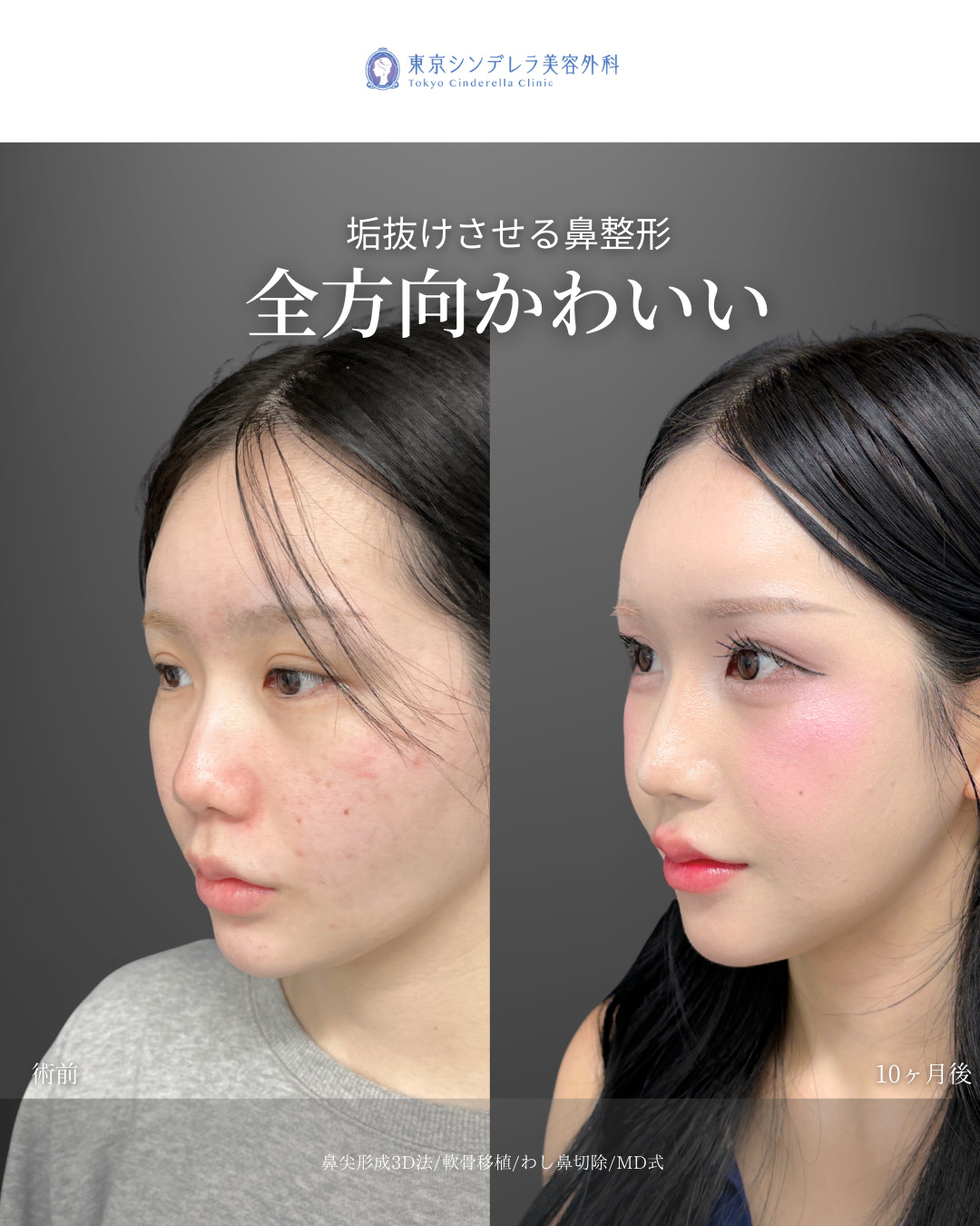 鼻尖形成3D法と軟骨移植とわし鼻切除をMD式で受けた女性の症例写真