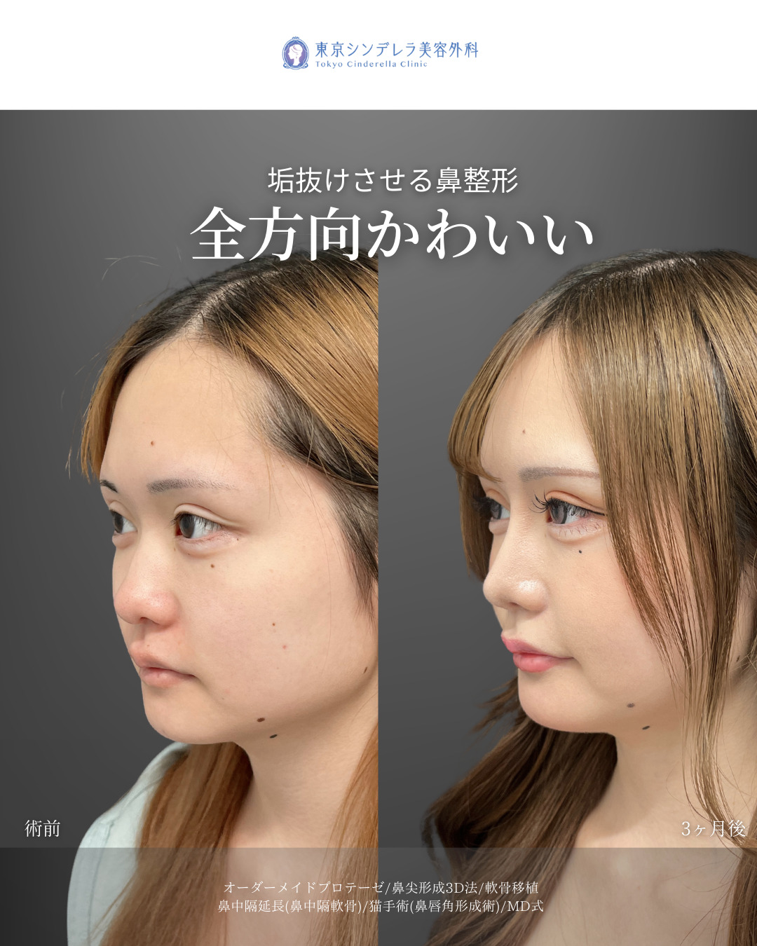 オーダーメイドプロテーゼと鼻尖形成3D法と軟骨移植と鼻中隔延長(鼻中隔軟骨)と猫手術(プロテーゼ)をMD式で受けた女性の症例写真