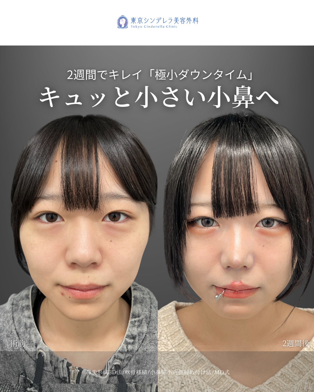 鼻尖形成3D法と軟骨移植と小鼻縮小内側締め付け法をMD式で受けた女性の症例写真