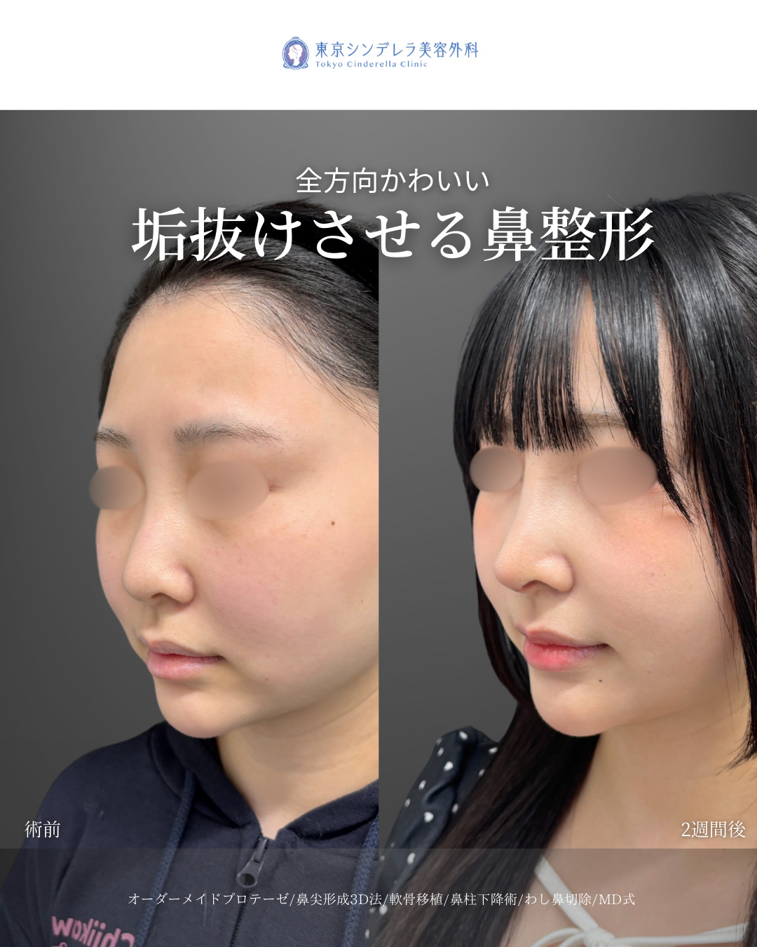 オーダーメイドプロテーゼと鼻尖形成3D法と軟骨移植と鼻柱下降術とわし鼻切除をMD式で受けた20代の女性の症例