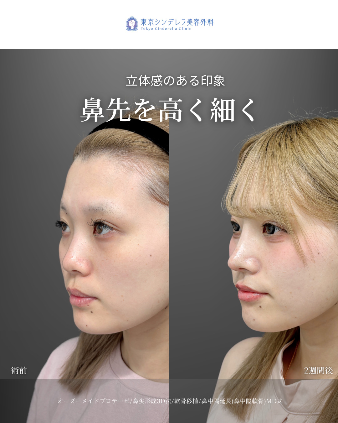 オーダーメイドプロテーゼと鼻尖形成3D法と軟骨移植と鼻中隔延長鼻中隔軟骨をMD式で受けた女性の症例写真