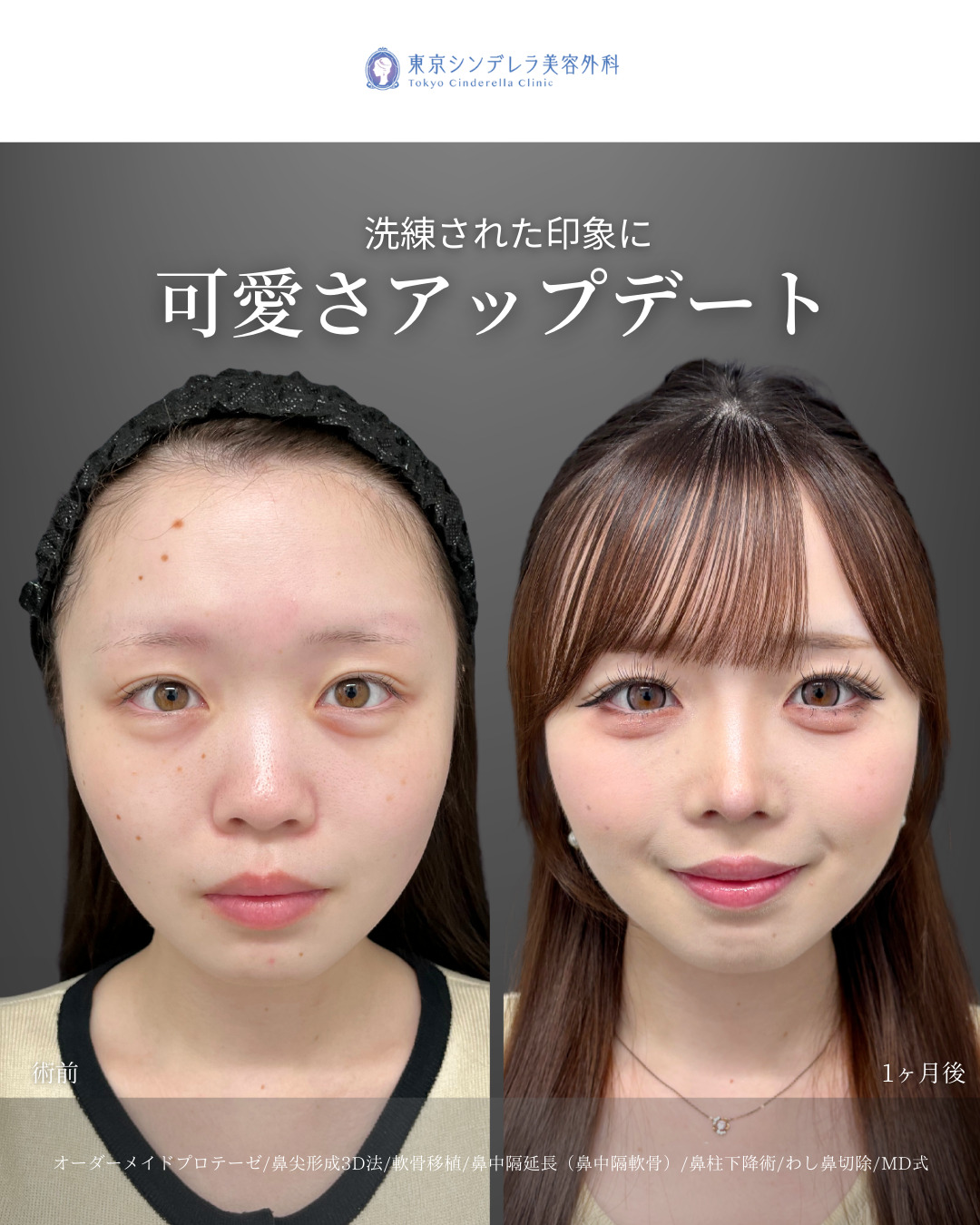 プロテーゼと鼻尖形成3D法と軟骨移植と鼻中隔延長とわし鼻切除と貴族ヒアルロン酸をMD式で受けた女性の症例写真