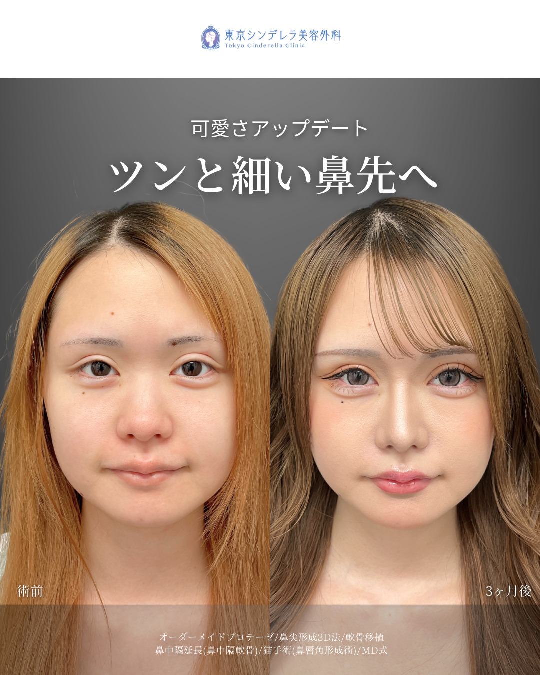 オーダーメイドプロテーゼと鼻尖形成3D法と軟骨移植と鼻中隔延長(鼻中隔軟骨)と猫手術(プロテーゼ)をMD式で受けた女性の症例写真