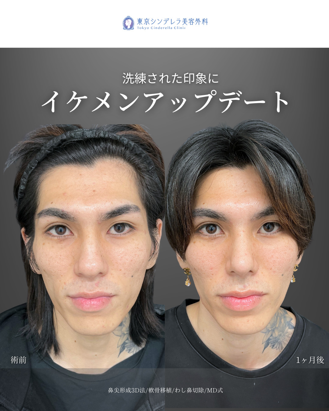 鼻尖形成3D法と軟骨移植とわし鼻切除をMD式で受けた男性の症例写真