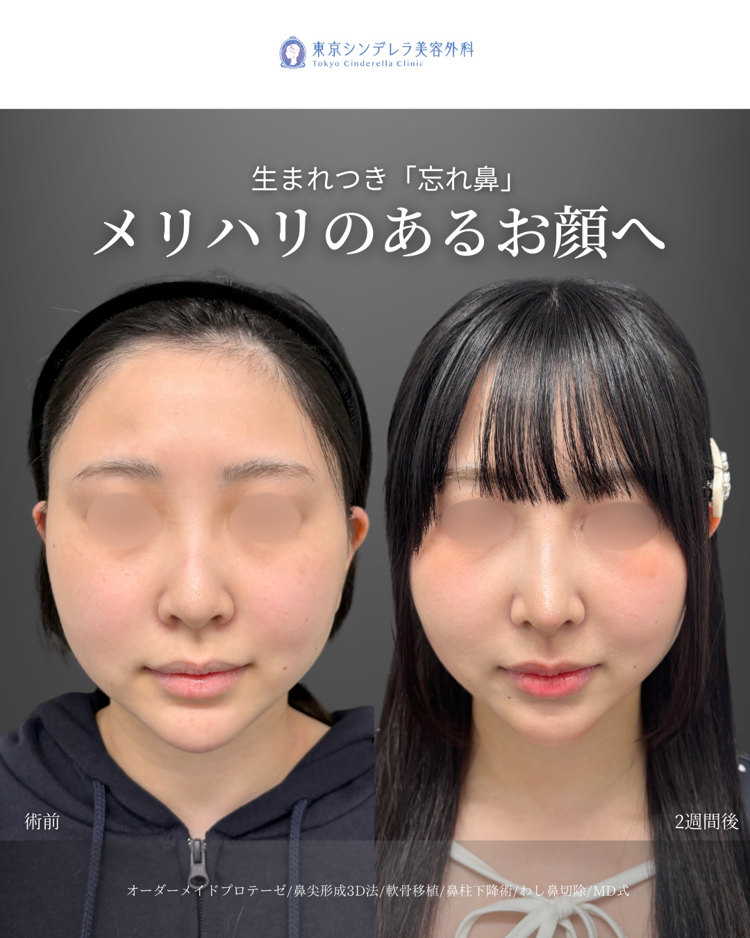オーダーメイドプロテーゼと鼻尖形成3D法と軟骨移植と鼻柱下降術とわし鼻切除をMD式で受けた20代の女性の症例