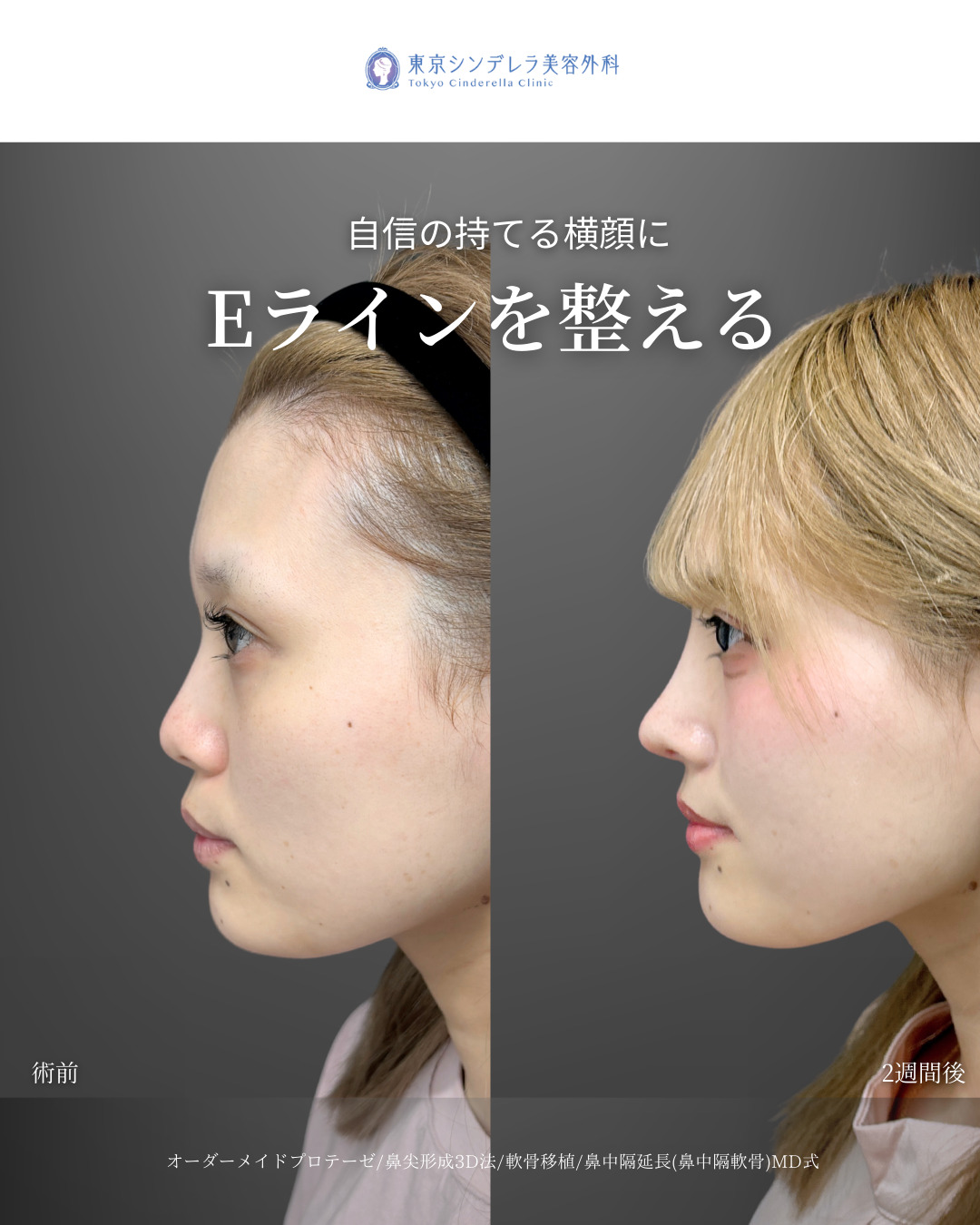 オーダーメイドプロテーゼと鼻尖形成3D法と軟骨移植と鼻中隔延長鼻中隔軟骨をMD式で受けた女性の症例写真