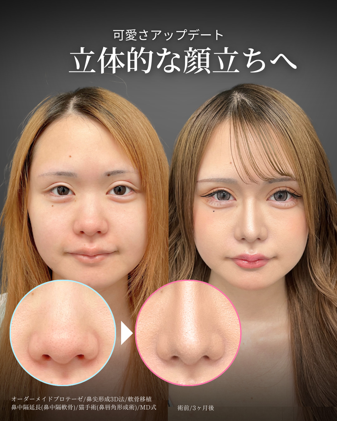 オーダーメイドプロテーゼと鼻尖形成3D法と軟骨移植と鼻中隔延長(鼻中隔軟骨)と猫手術(プロテーゼ)をMD式で受けた女性の症例写真