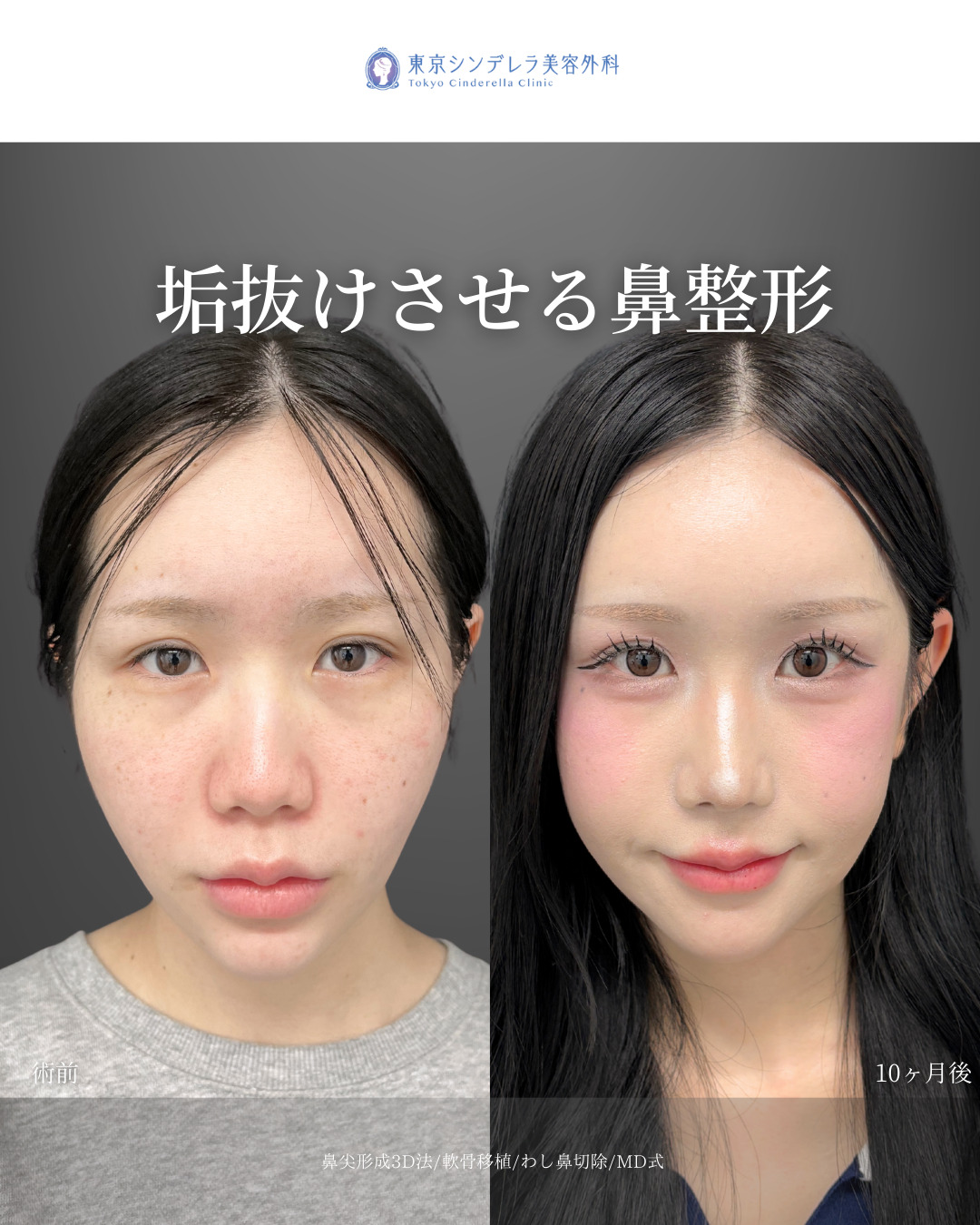 鼻尖形成3D法と軟骨移植とわし鼻切除をMD式で受けた女性の症例写真