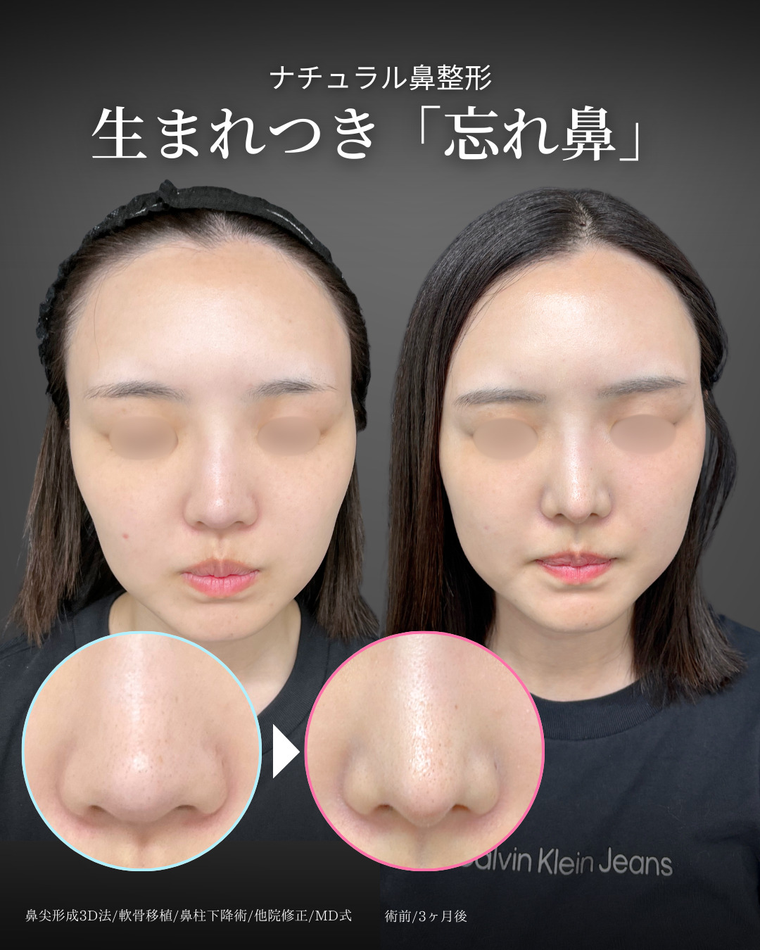 忘れ鼻形成