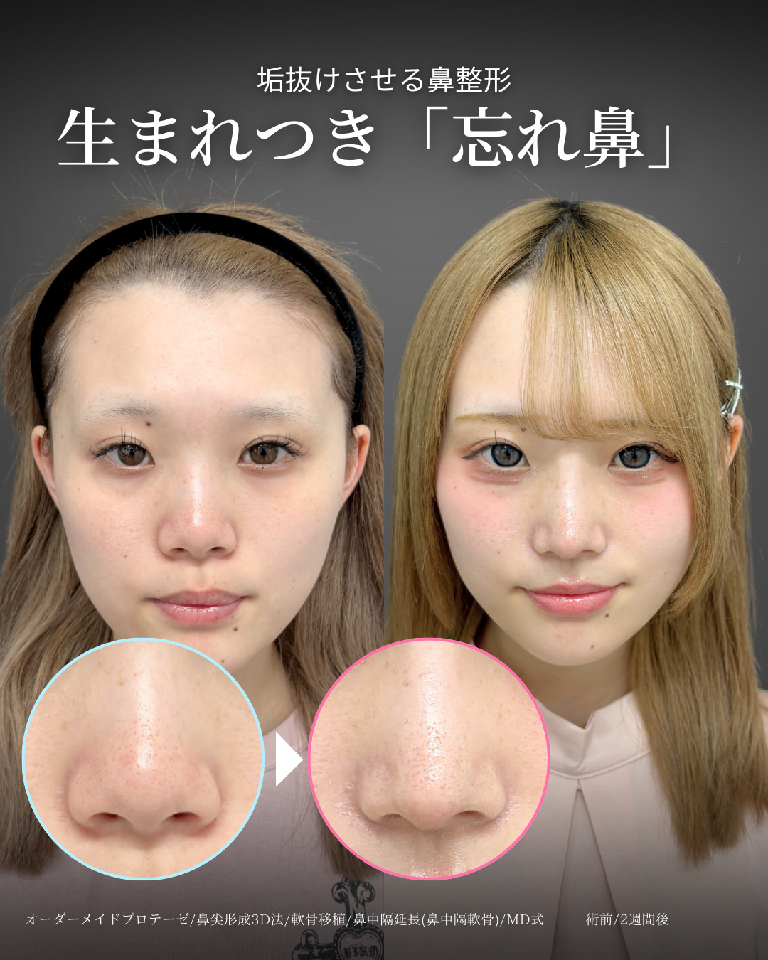 オーダーメイドプロテーゼと鼻尖形成3D法と軟骨移植と鼻中隔延長鼻中隔軟骨をMD式で受けた女性の症例写真