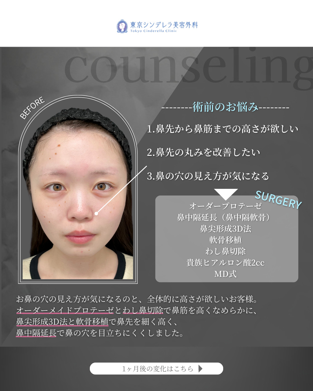 プロテーゼと鼻尖形成3D法と軟骨移植と鼻中隔延長とわし鼻切除と貴族ヒアルロン酸をMD式で受けた女性の症例写真