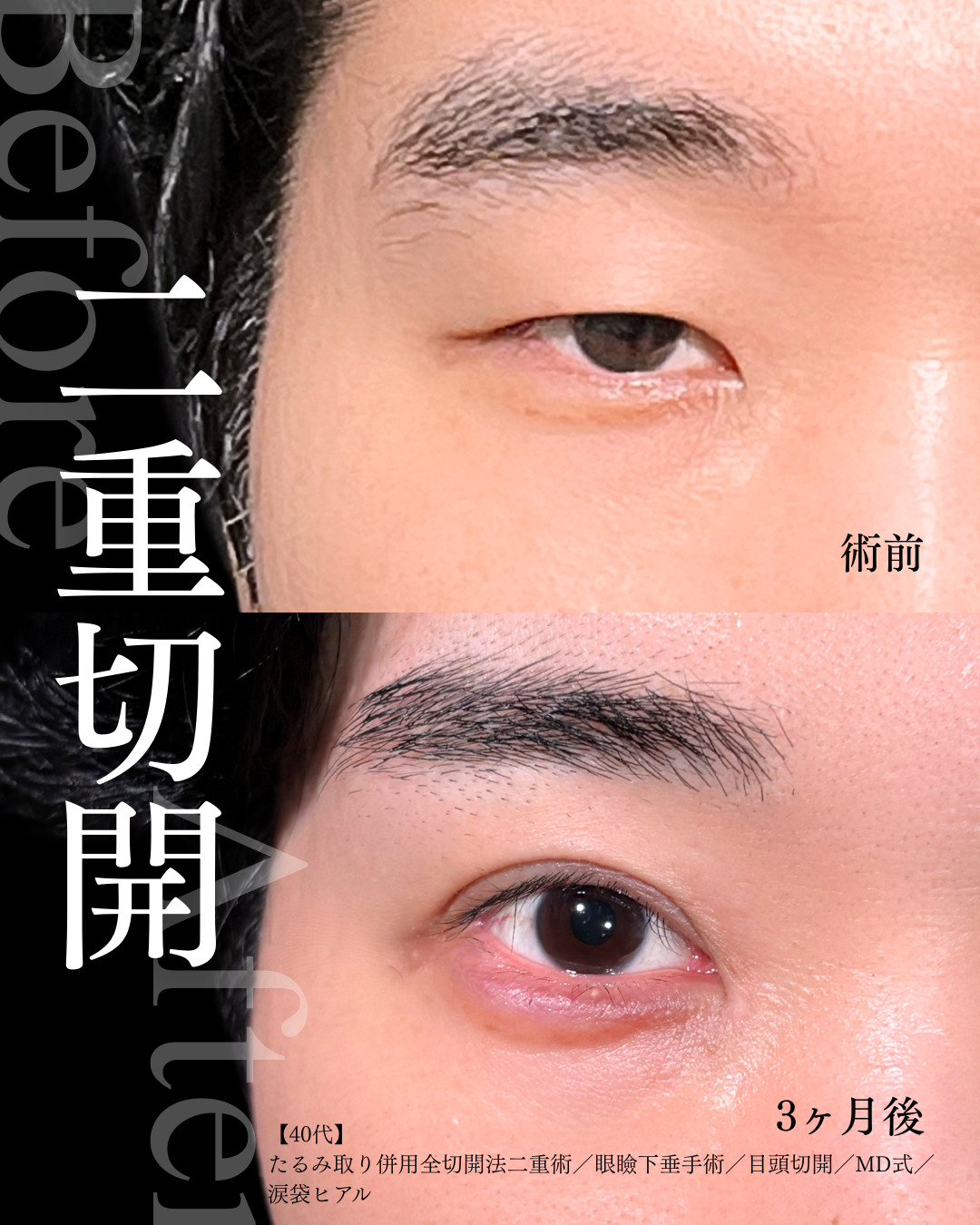 大宮院で行った二重整形で有名な竹田昌平医師の全切開二重術と眼瞼下垂手術と目頭切開の症例写真