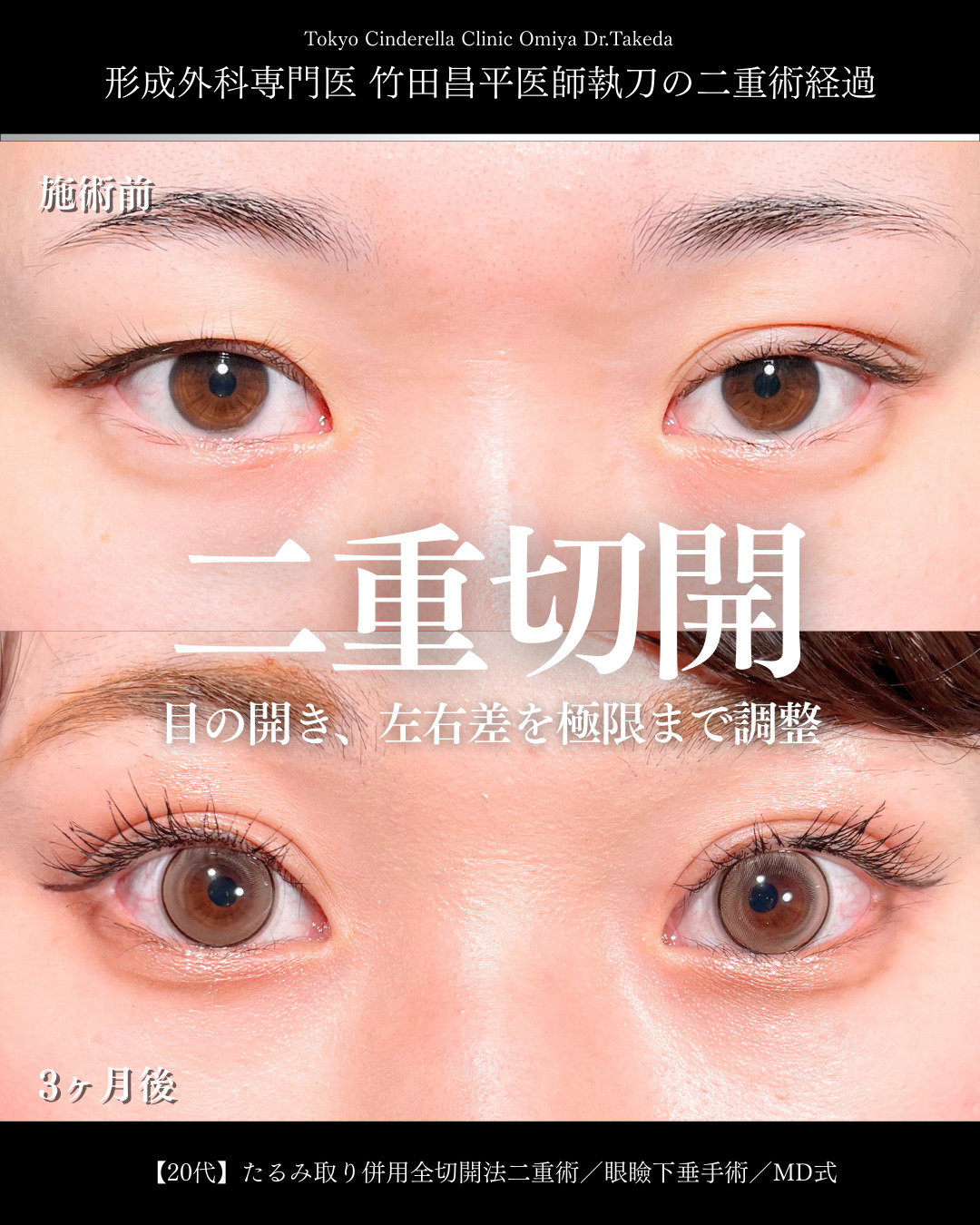 大宮院で行った二重整形で有名な名医の竹田昌平医師の全切開二重術と眼瞼下垂修正術の症例写真