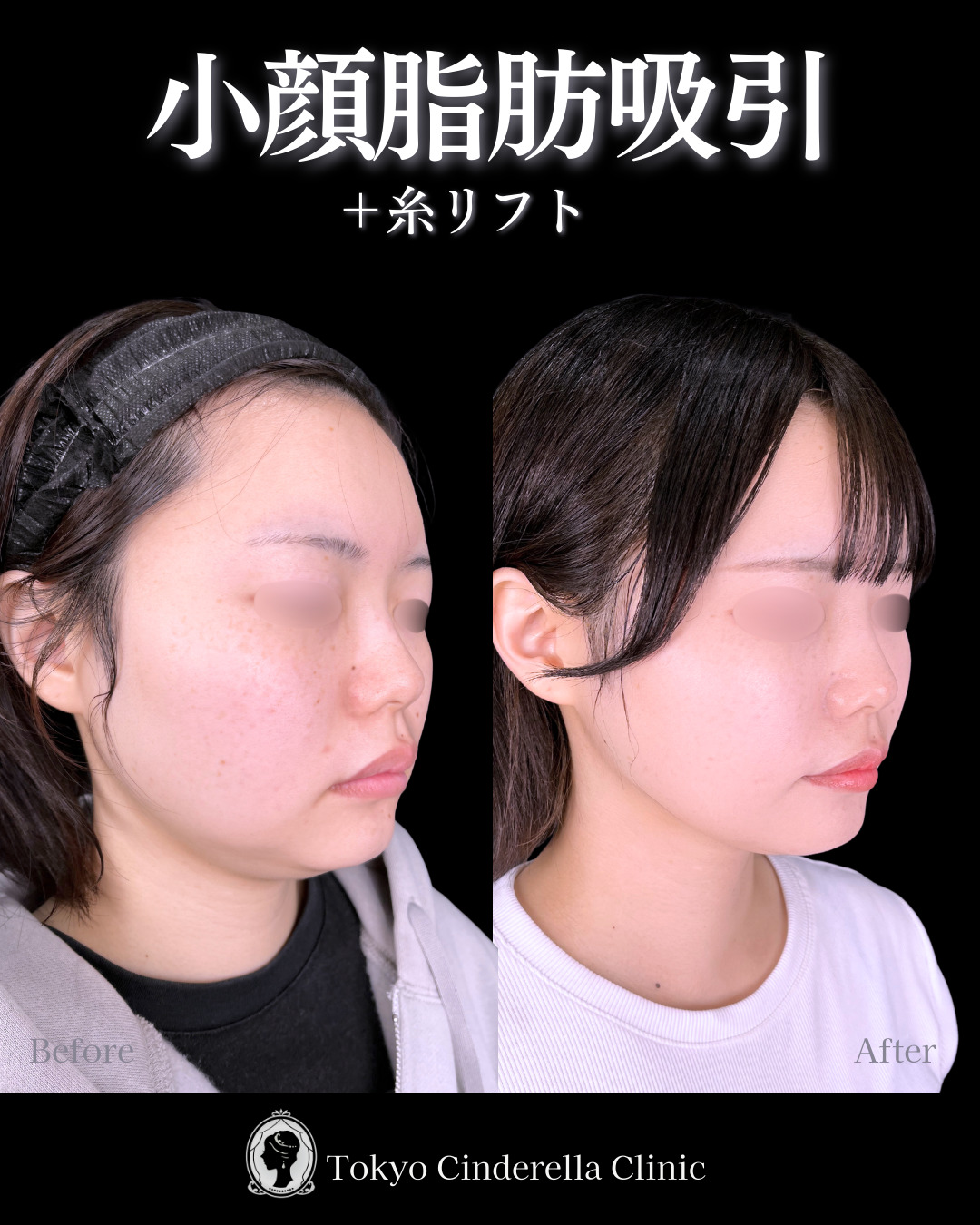 池袋院で行った小顔脂肪吸引(頬・あご下・エラ下) と糸リフトの名医の症例写真