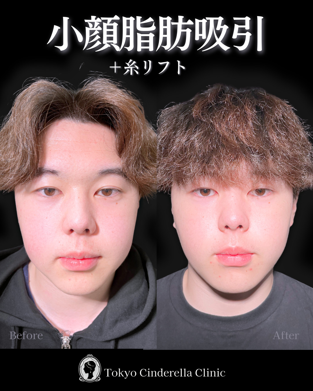 池袋院で行ったアキーセル小顔脂肪吸引(頬・あご下・エラ下・ジョールファット) と糸リフト6本の名医の症例写真