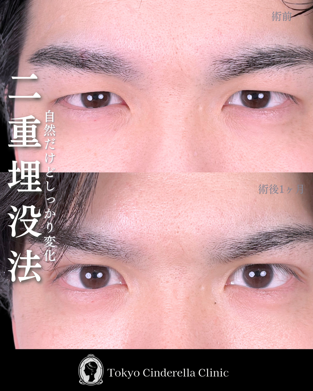 池袋院で行った二重埋没法整形の名医の症例写真